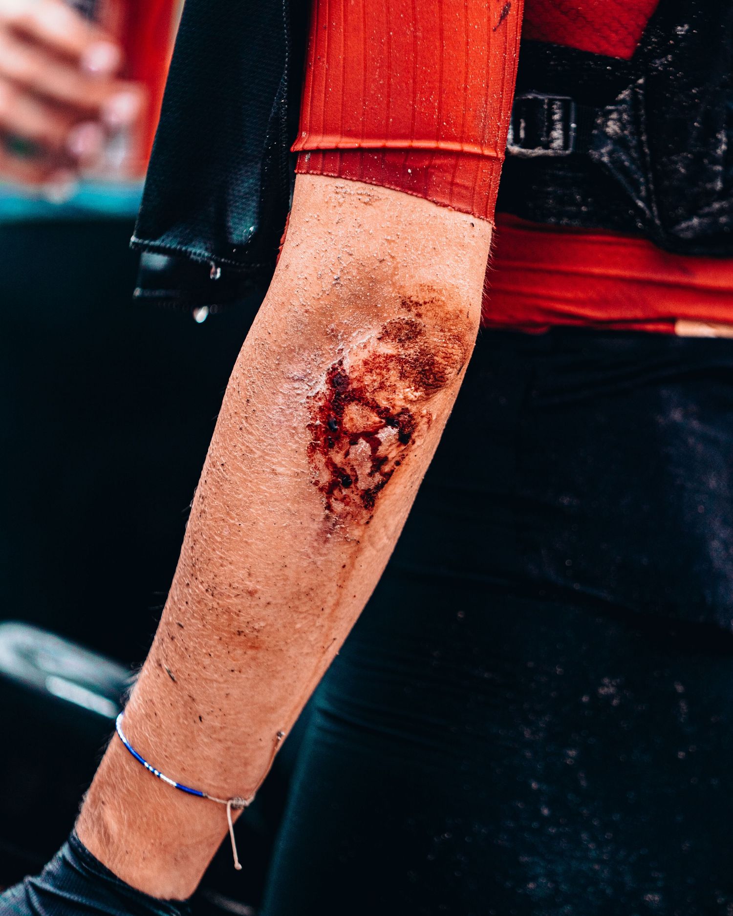 Close-up of a severe road rash wound on a cyclist's forearm, with a blue bracelet visible on the wrist.