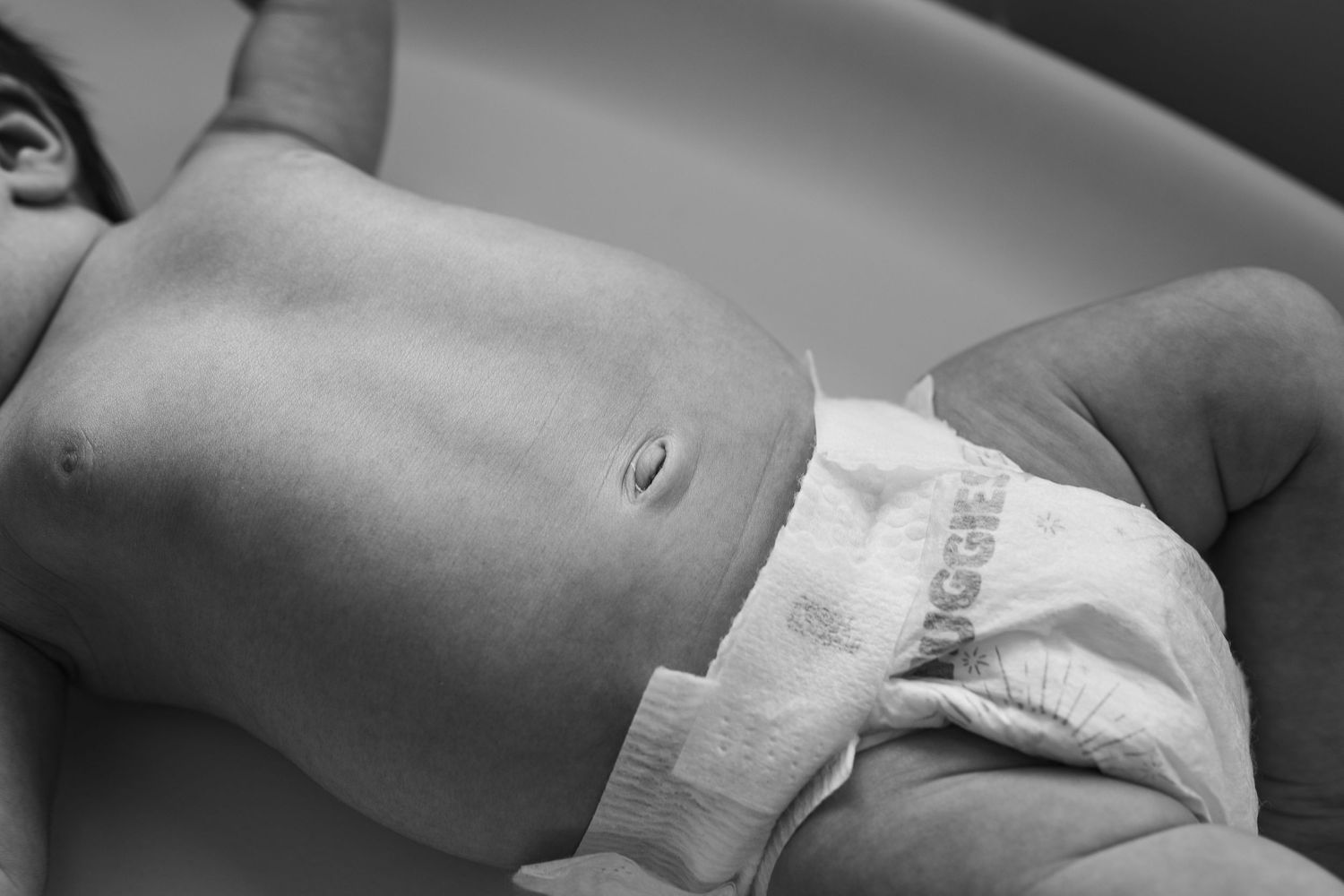 Hospital identification bracelet and medical details from newborn care.