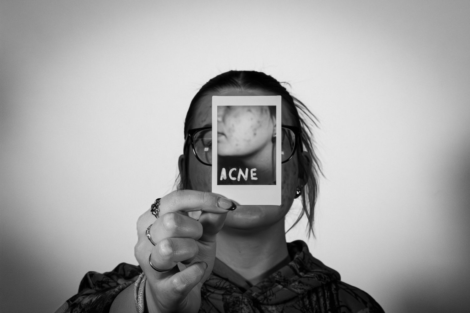 Person holding a Polaroid photo labeled ACNE covering their face in a black and white portrait.
