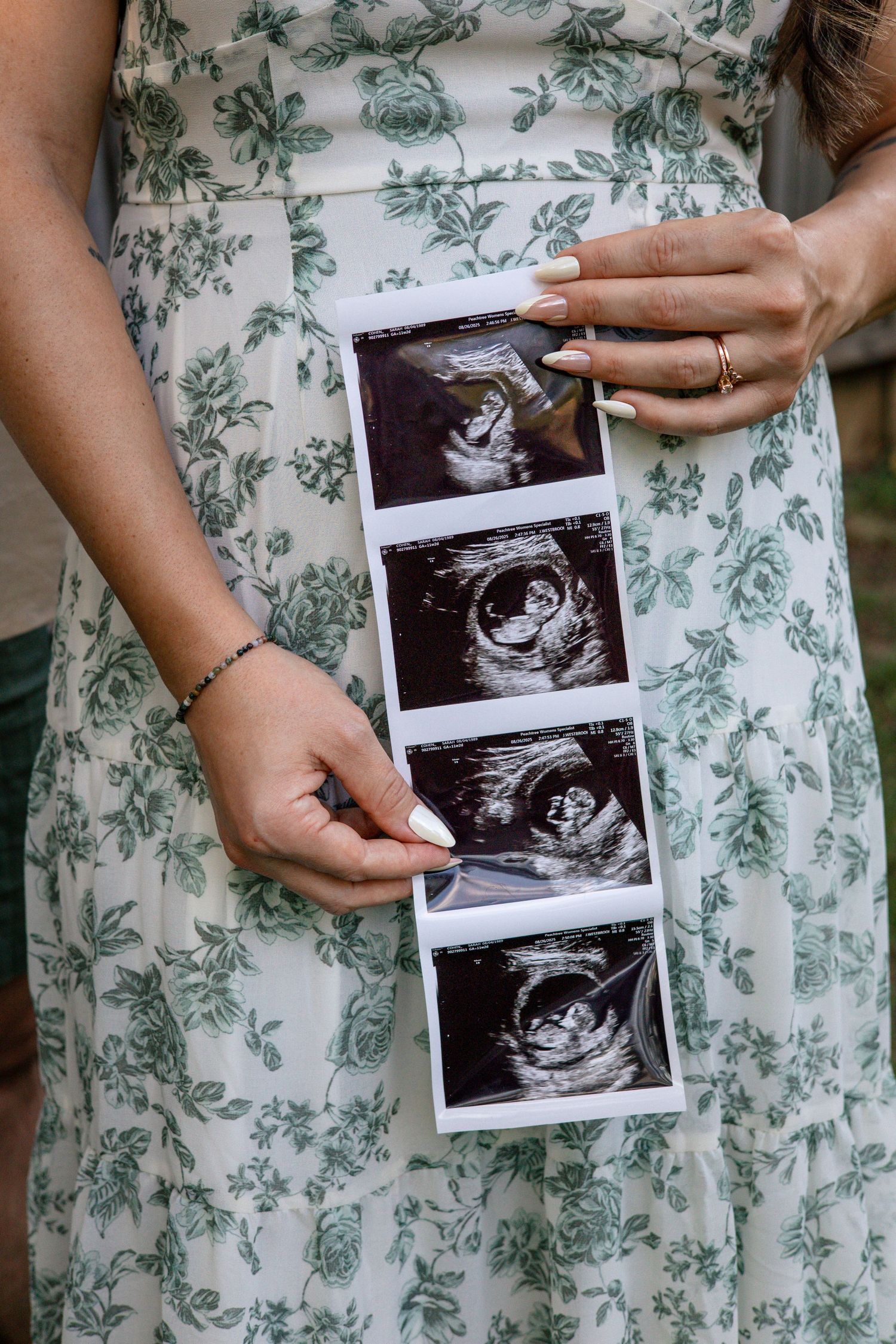 Hands holding ultrasound photos against a floral dress showing stages of pregnancy development.