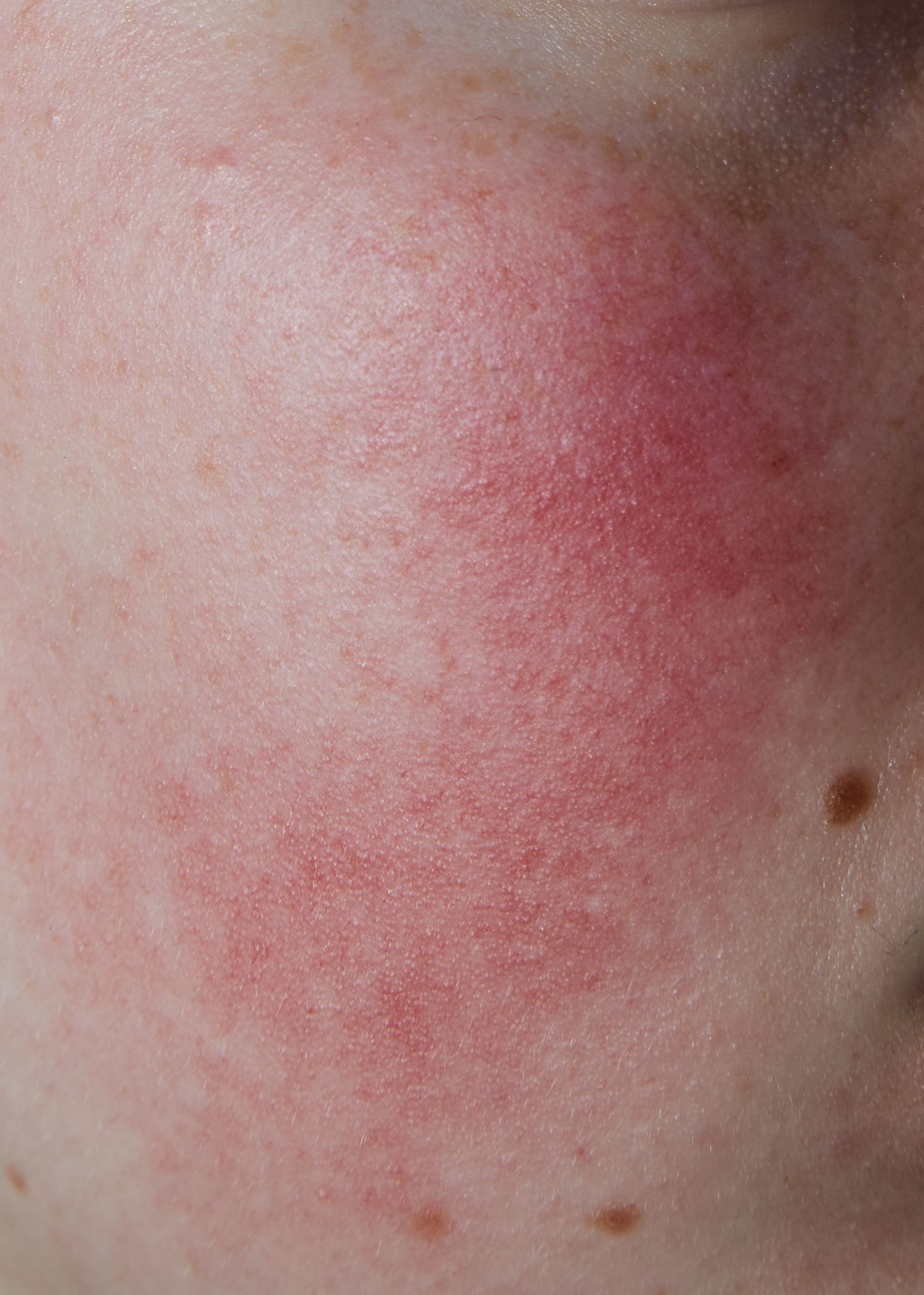 Close-up of red, irritated skin showing a rash or allergic reaction.
