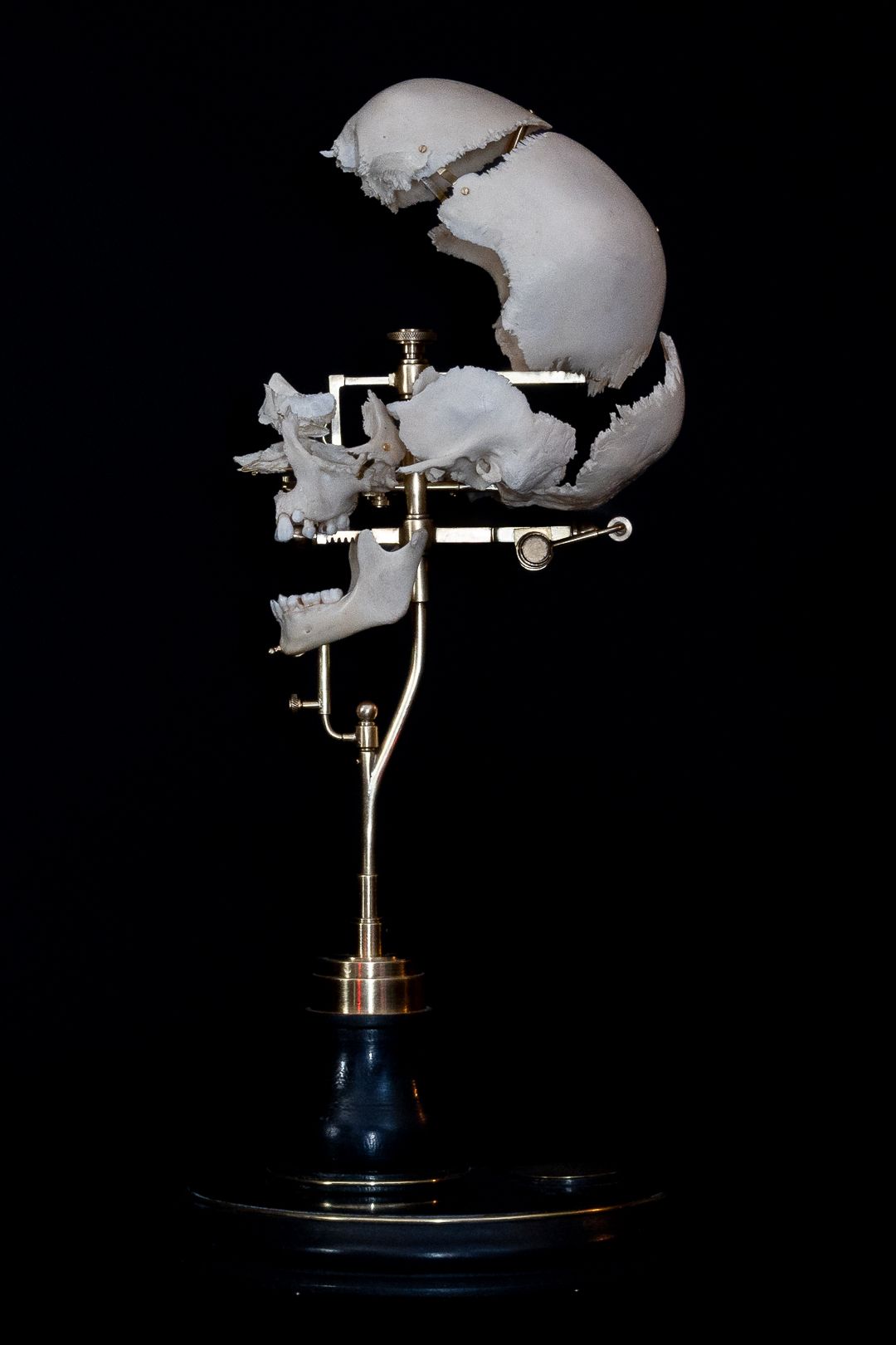Anatomical skull specimen with separated cranial sections mounted on metal display stand.