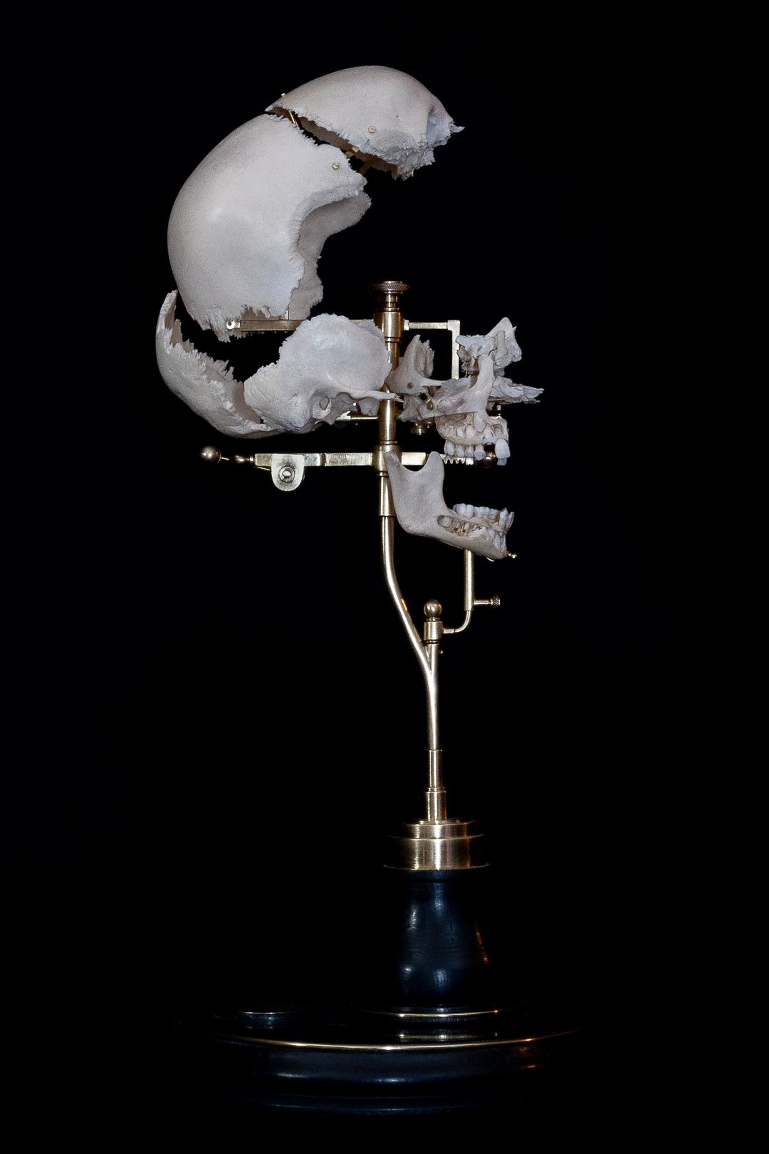 Profile view of medical skull specimen mounted on blue base with metal support system.