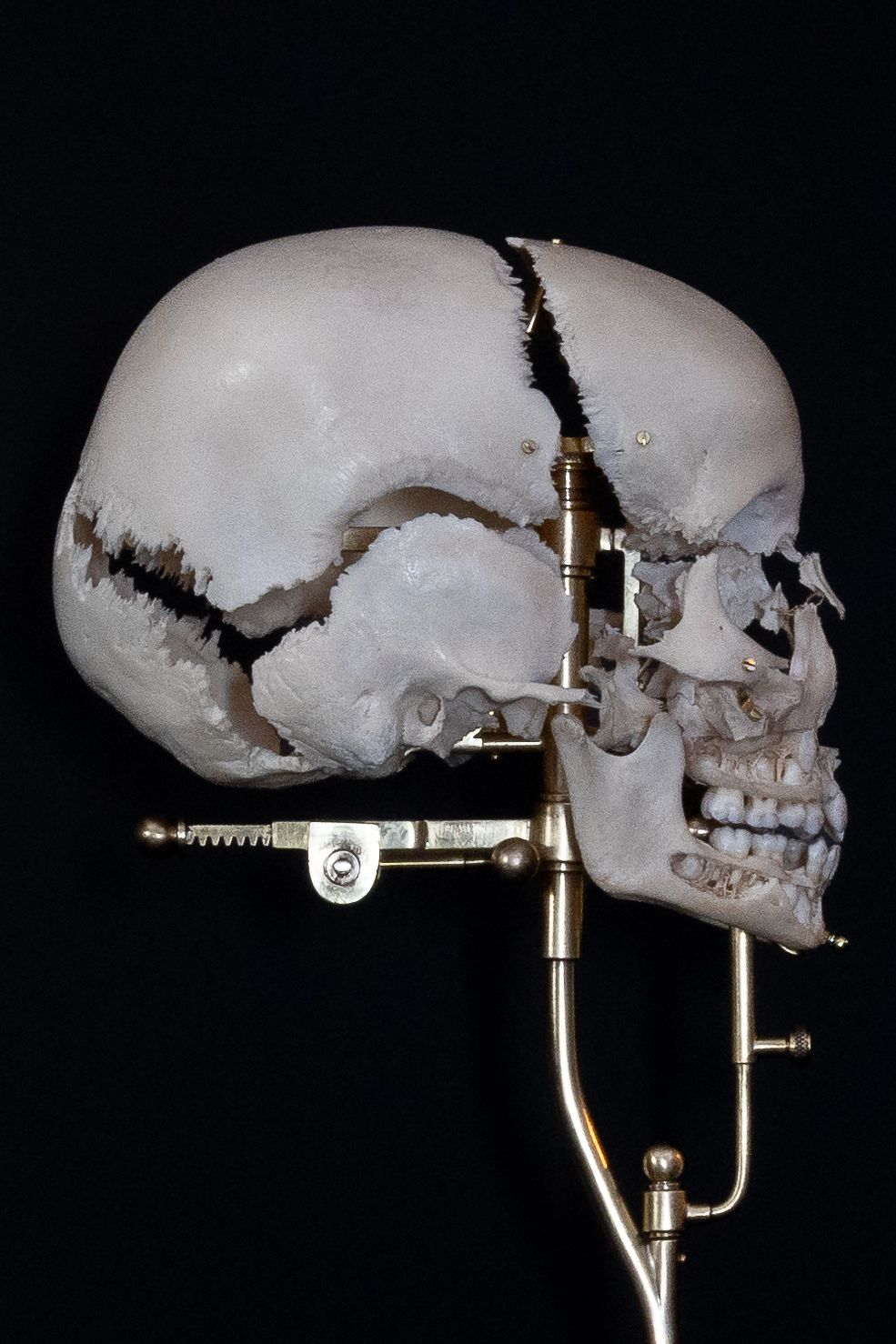 Side view of a human skull specimen mounted on a metal stand against black background.