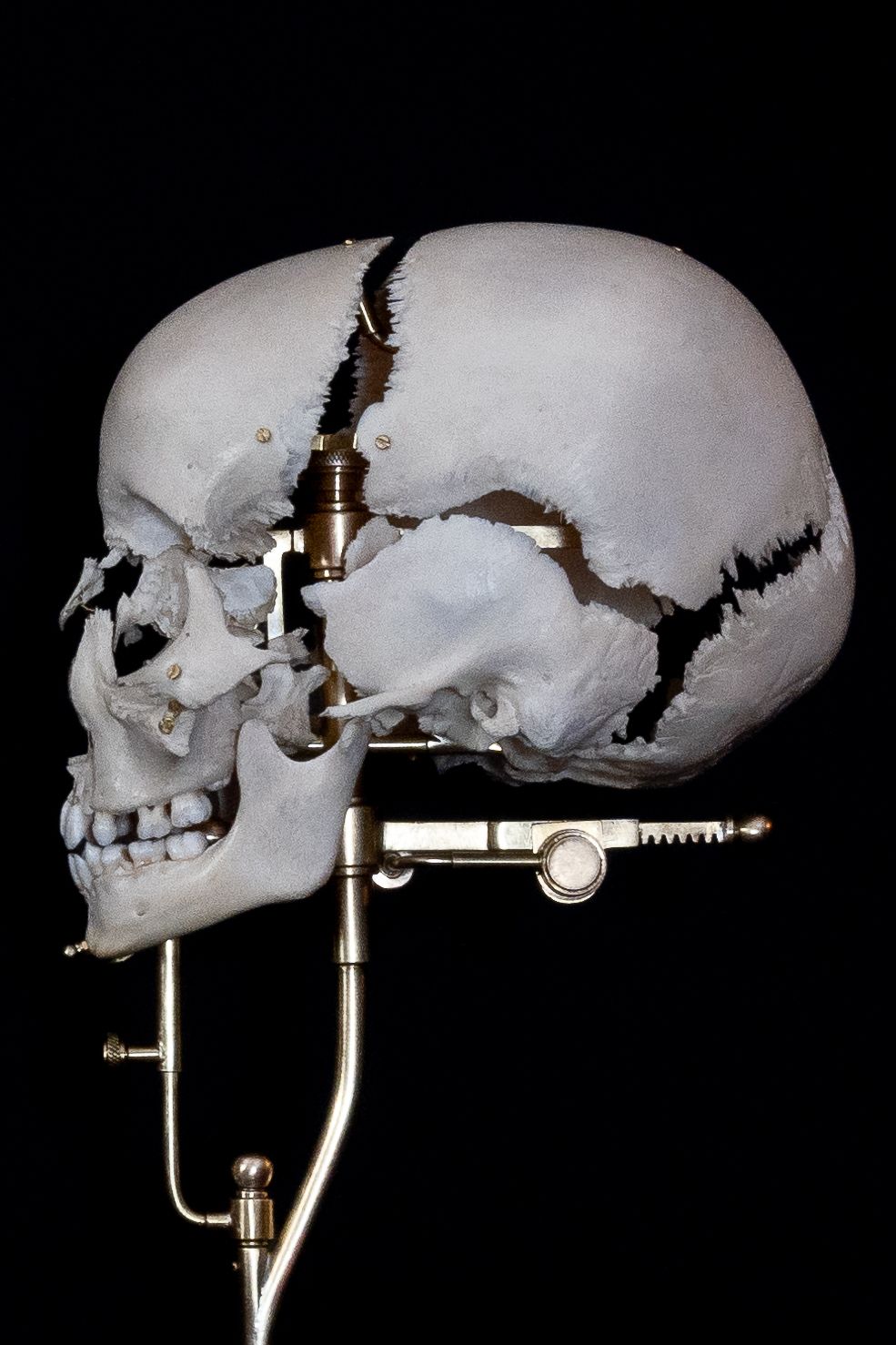 White skull with visible fracture lines mounted on adjustable metal apparatus.