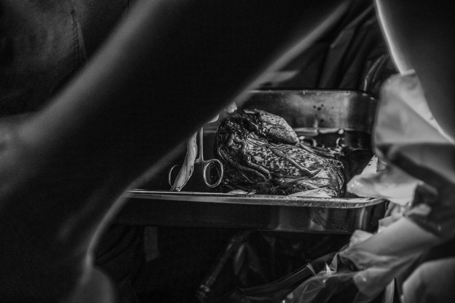 A black and white macro photo shows surgical instruments and tools during a medical procedure.