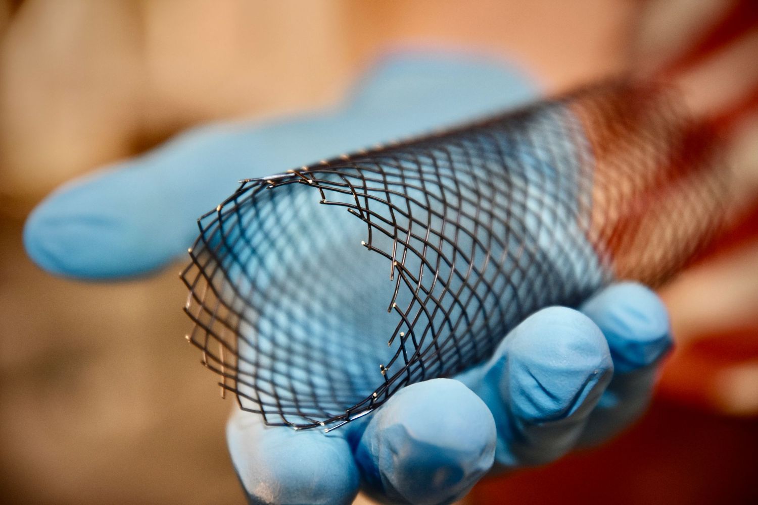 Gloved hand holding a cylindrical medical mesh stent device used in surgical procedures.