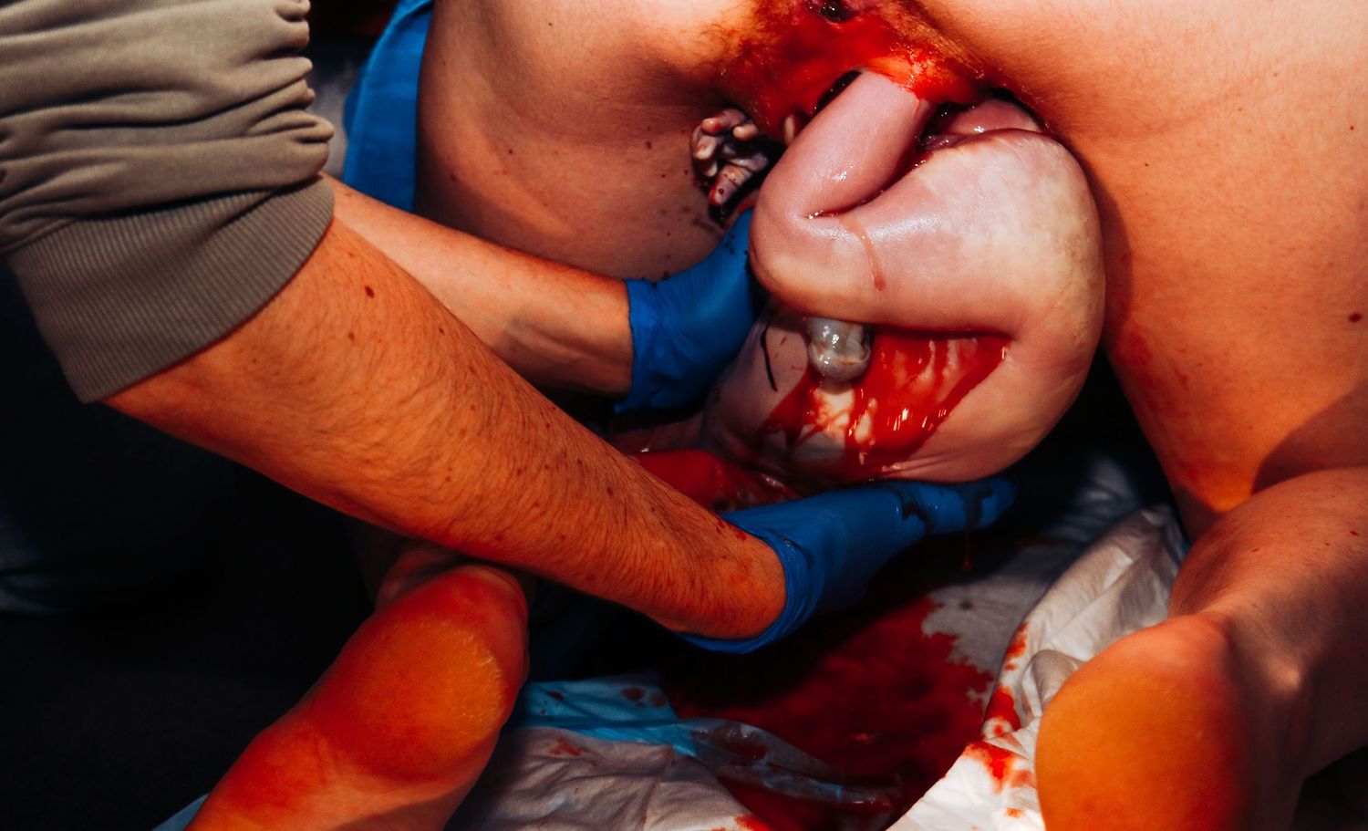 Medical professionals assisting with a childbirth delivery, showing a newborn baby being born in a clinical setting.