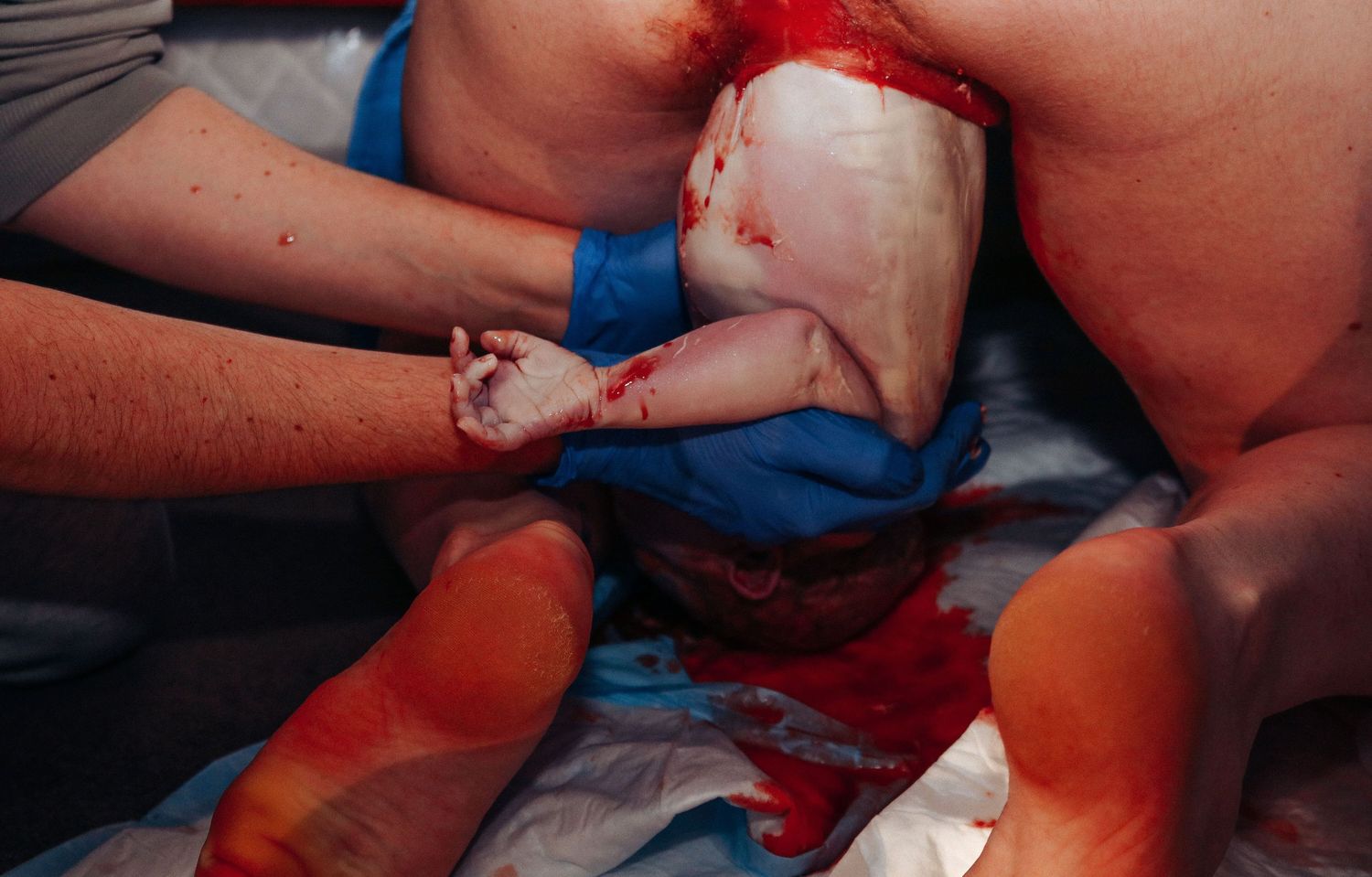 A newborn baby being delivered covered in blood during childbirth with medical staff assisting.