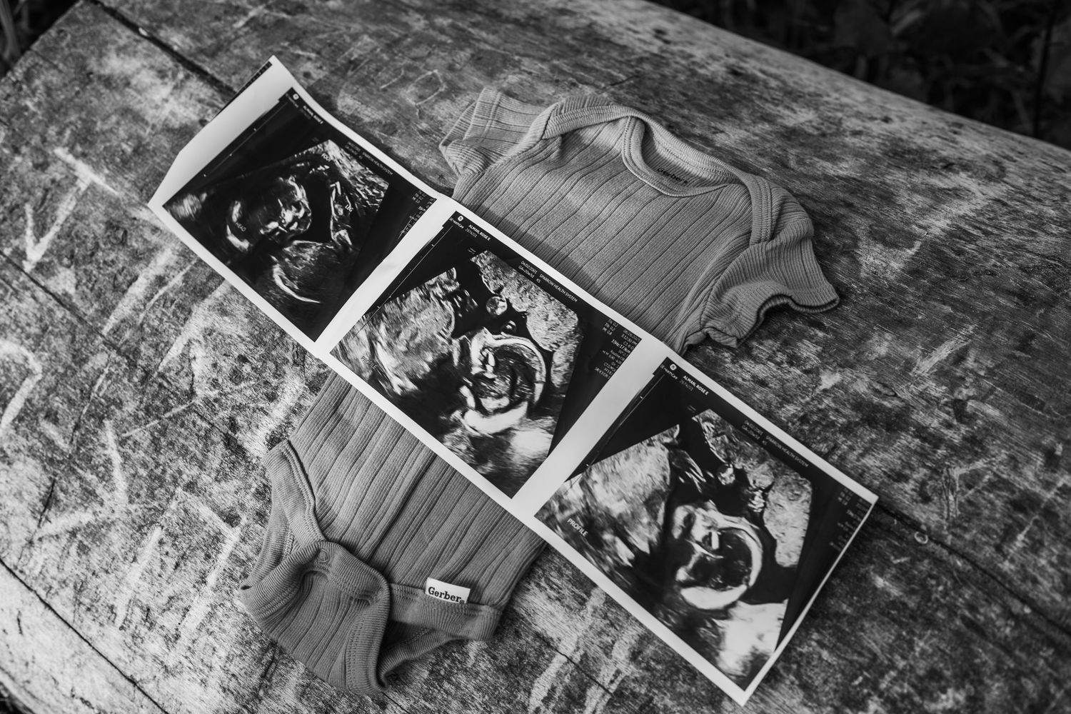 Ultrasound scan photos displayed on a textured surface in monochrome.