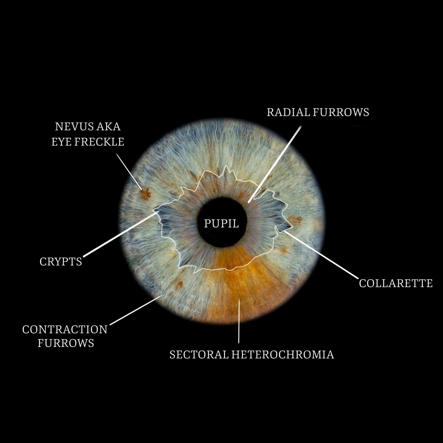 Detailed anatomical diagram of a human eye iris labeling pupil, collarette, crypts, radial furrows, and sectoral heterochromia.