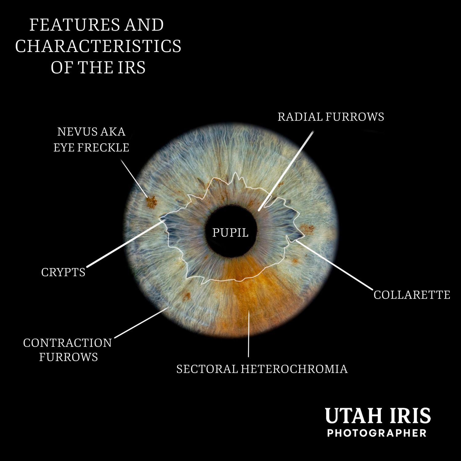 Labeled diagram of an iris showing radial furrows, collarette, sectoral heterochromia, and crypts against black background.