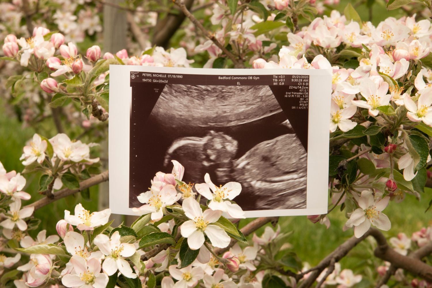 Ultrasound photo displayed among blooming white and pink spring flowers on a tree branch.