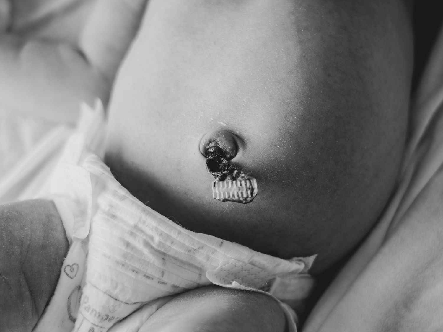 Close-up black and white photograph of a newborn's belly button and torso.