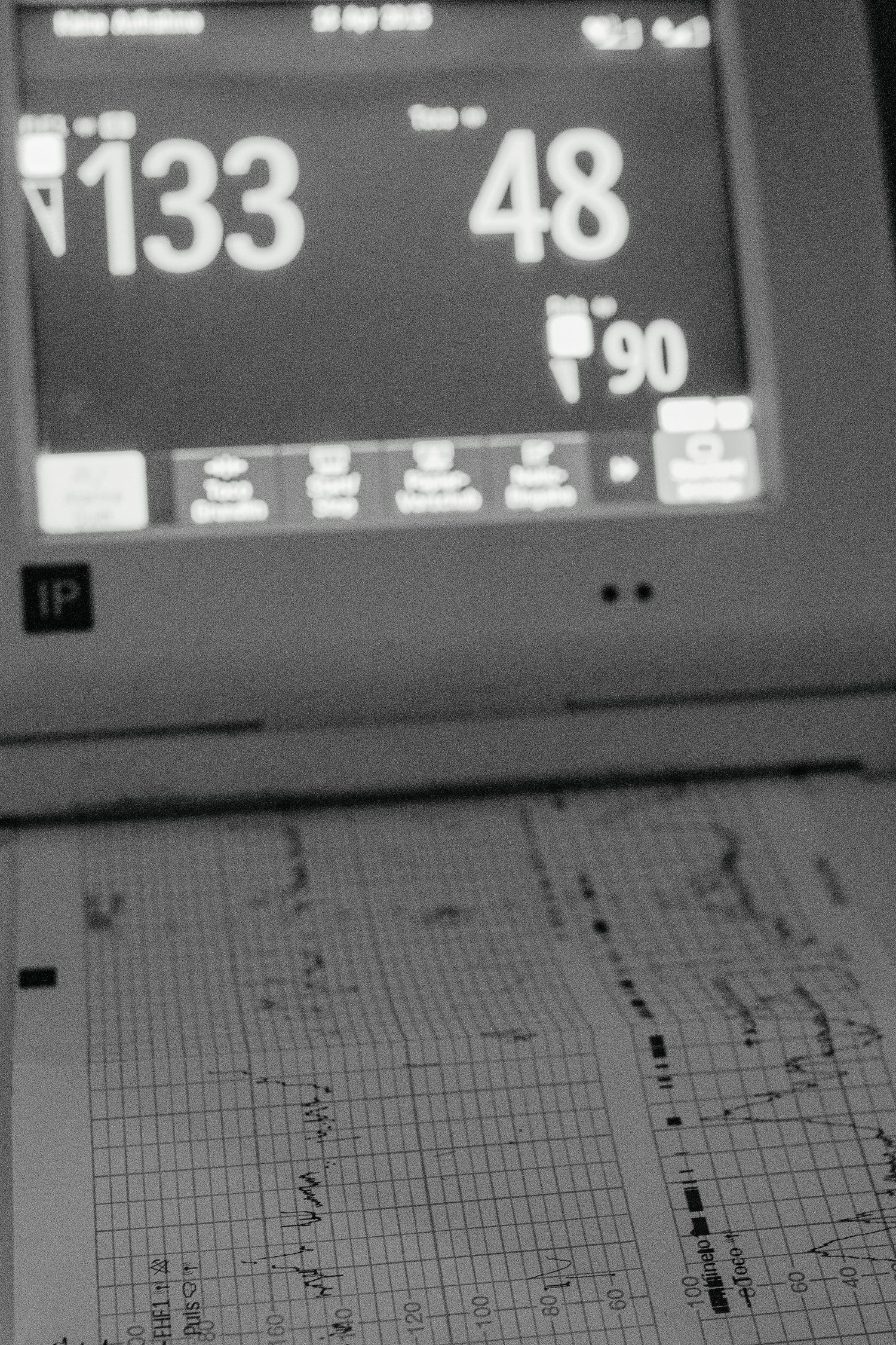 Cardiotocograph (CTG machine) during childbirth in Newport Beach.