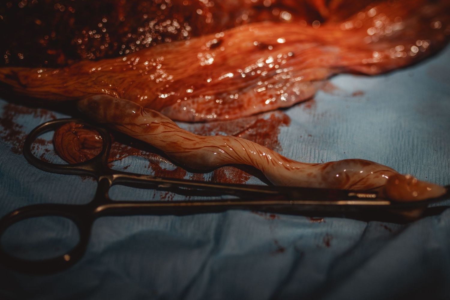 Placenta with umbilical cord after childbirth in Newport Beach.