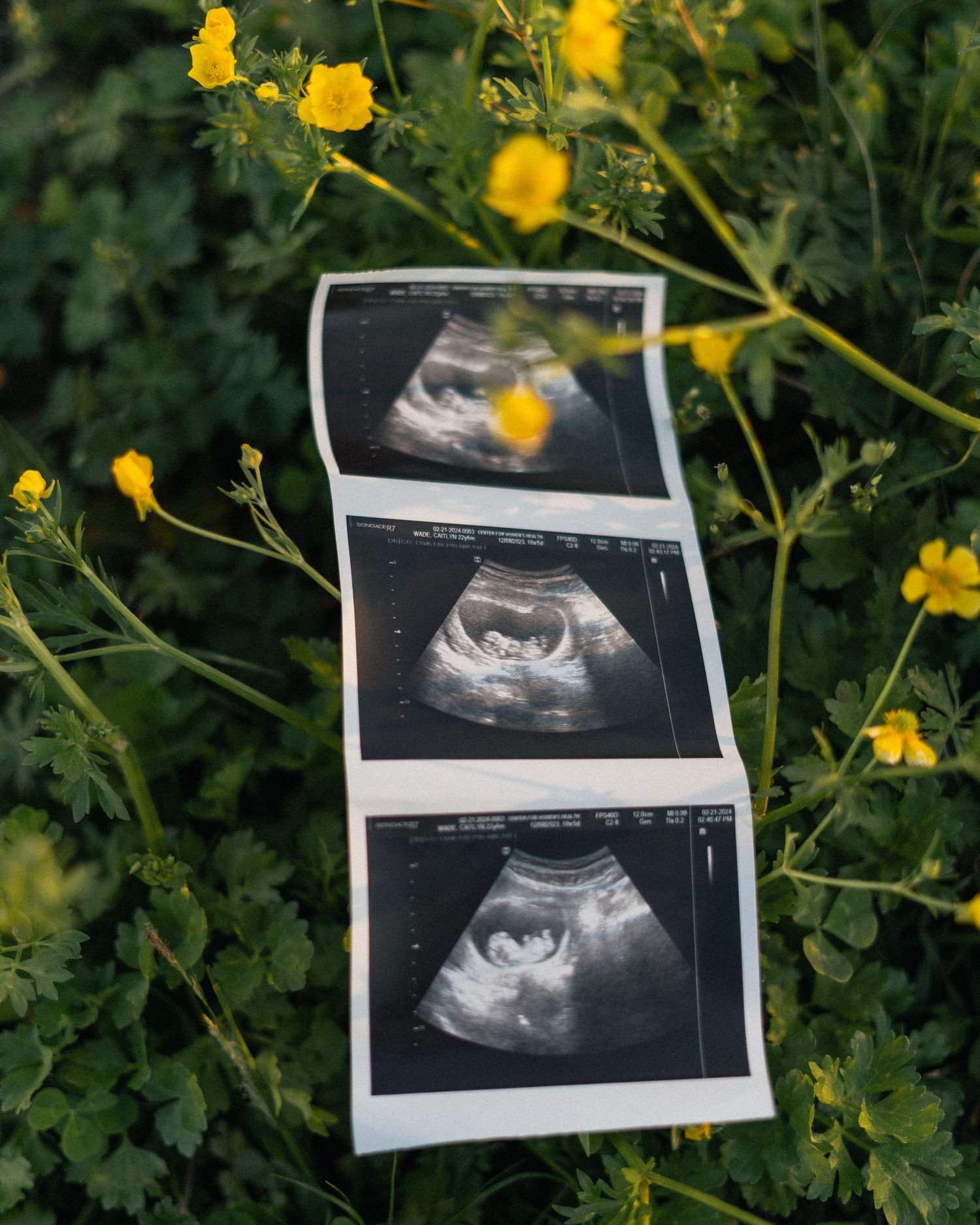 Three ultrasound photos arranged on green foliage with yellow wildflowers in natural setting.