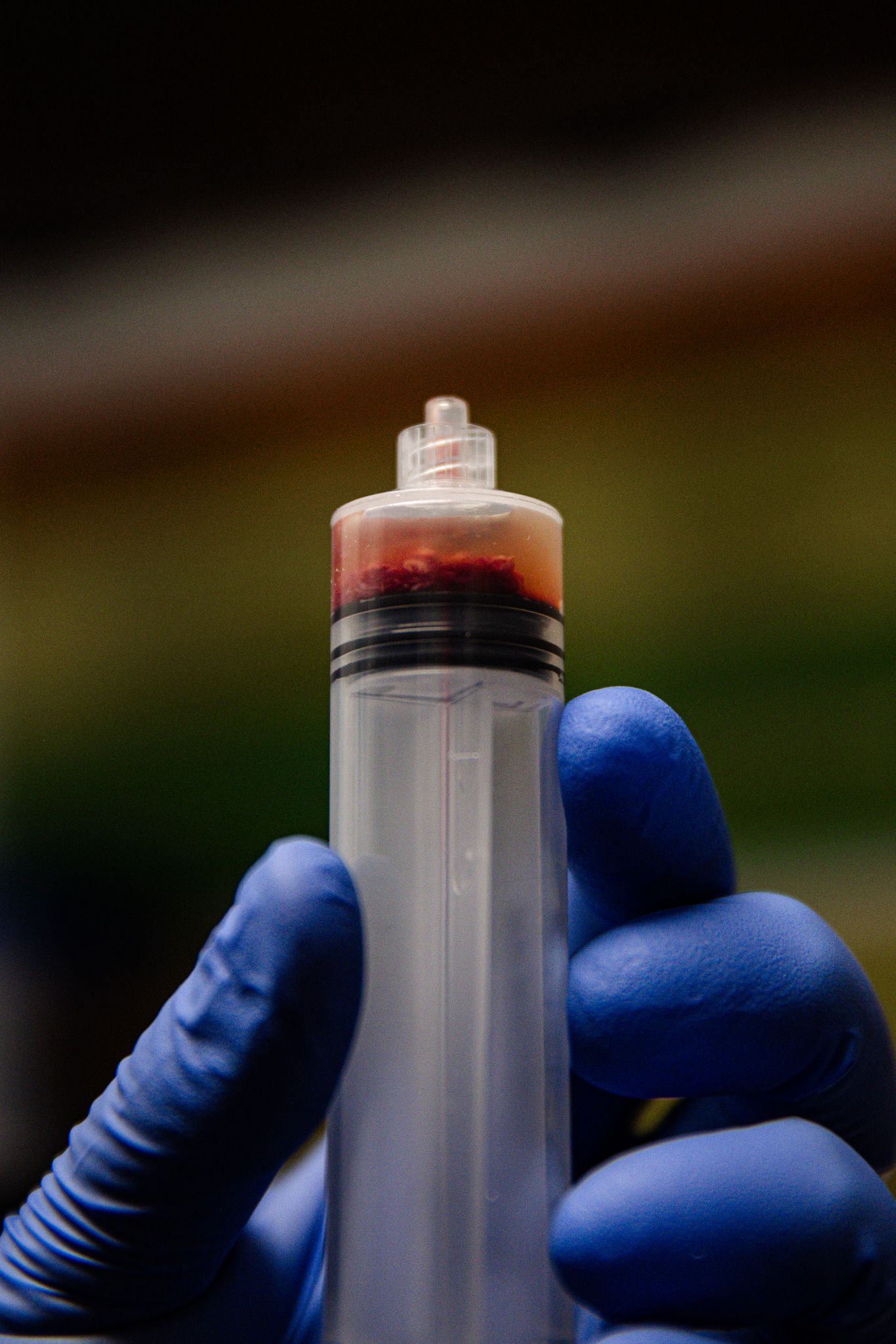 Close-up of a blue-gloved hand holding a large syringe filled with dark red platelet-rich plasma blood.