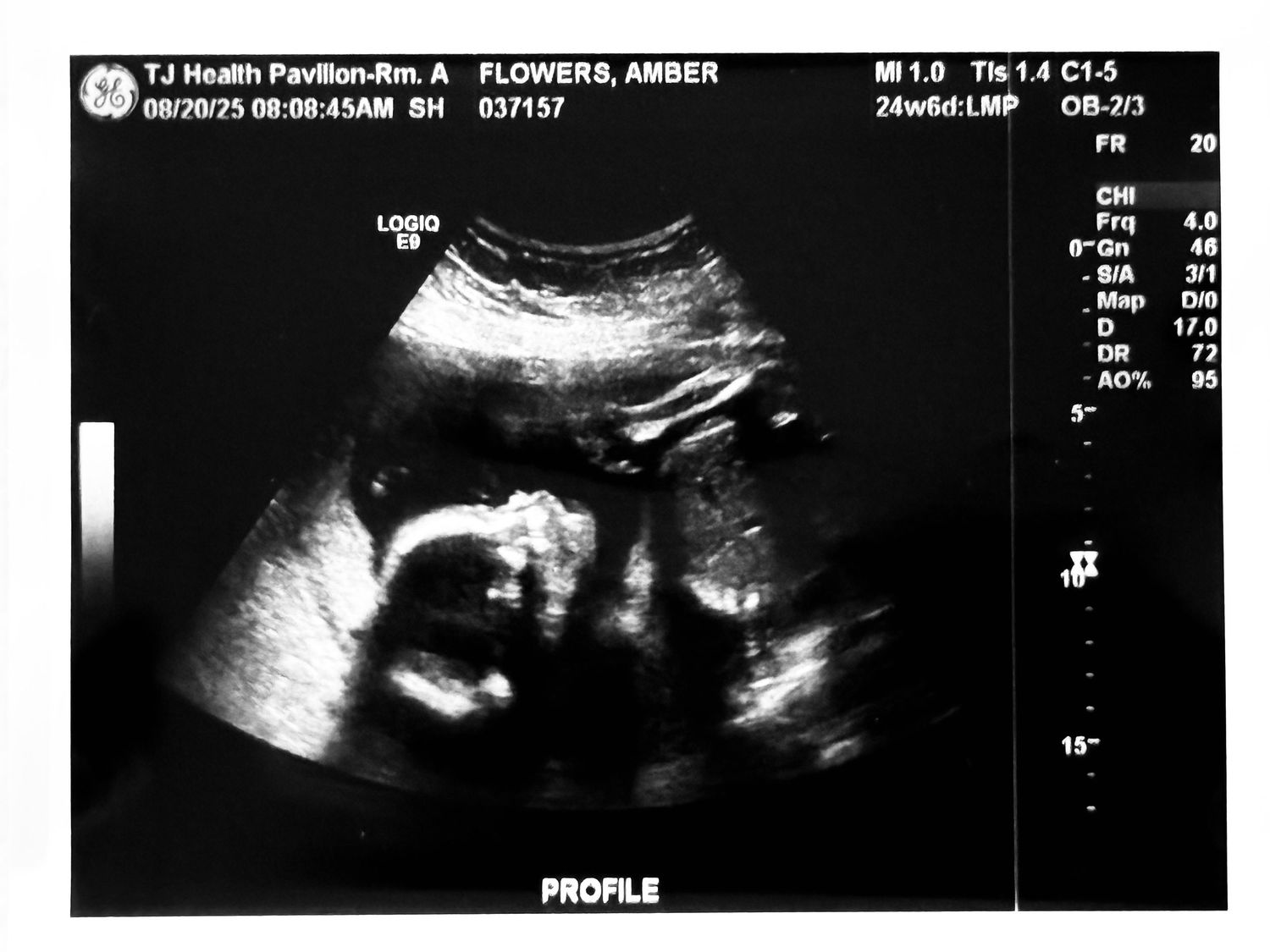 Six black and white ultrasound images showing different angles and perspectives of a developing fetus in the womb.