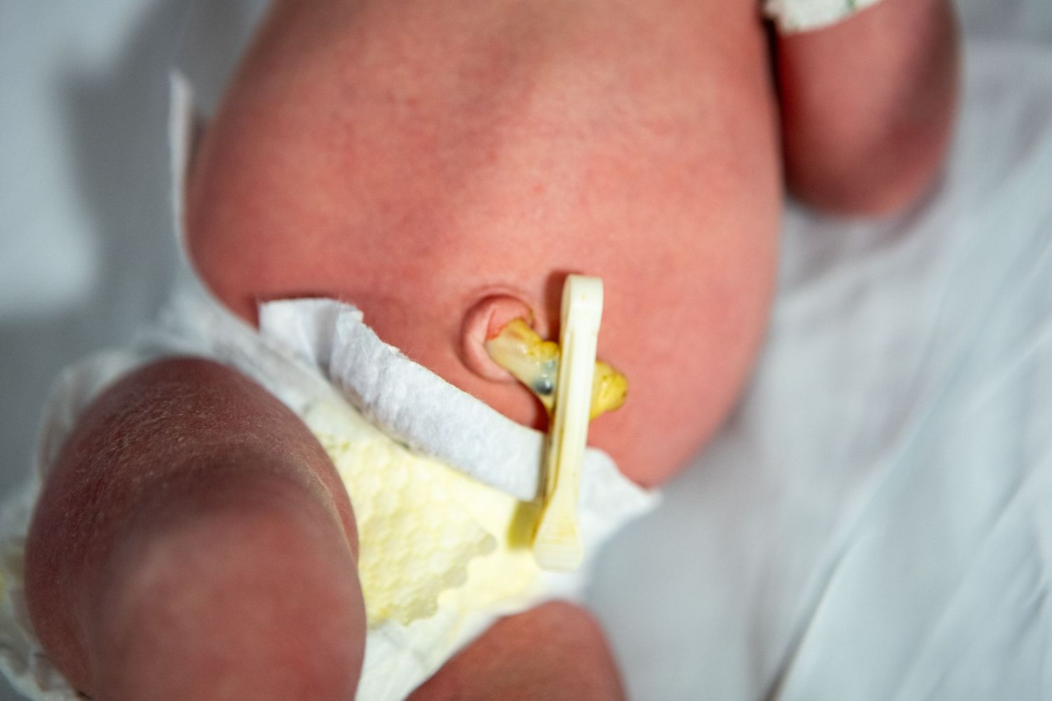 Newborn baby receiving medical care with yellow tube visible.
