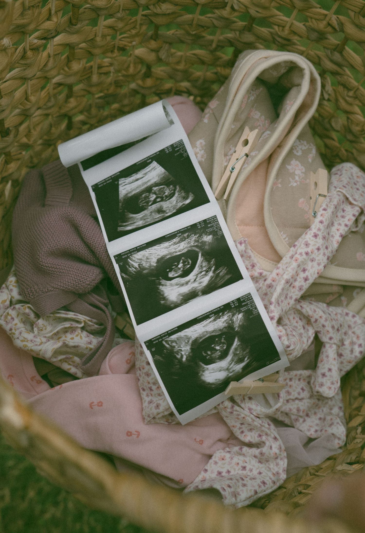 Ultrasound photos displayed with delicate lace and fabric accessories.