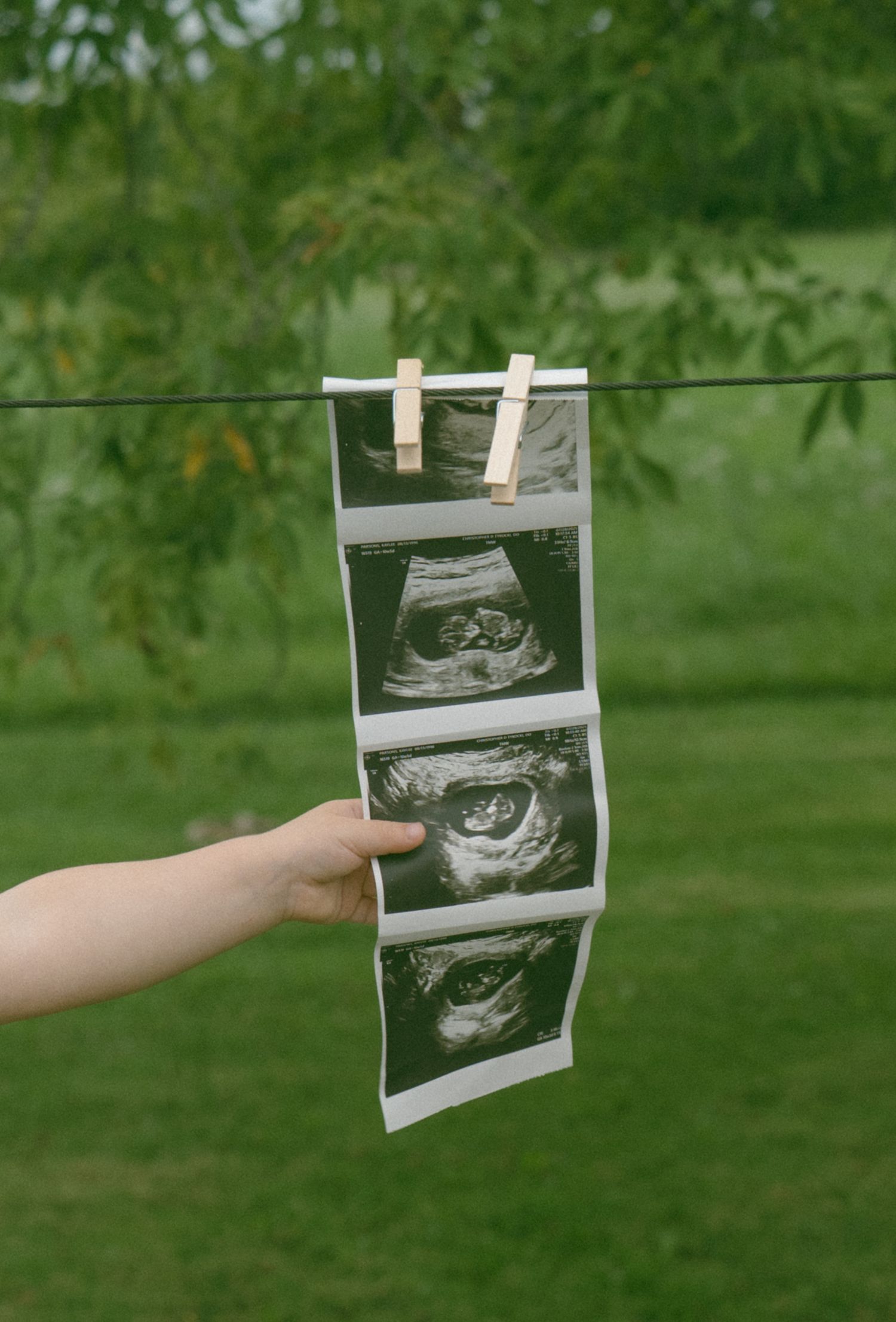 A strip of ultrasound photos clipped to a clothesline against a green background.