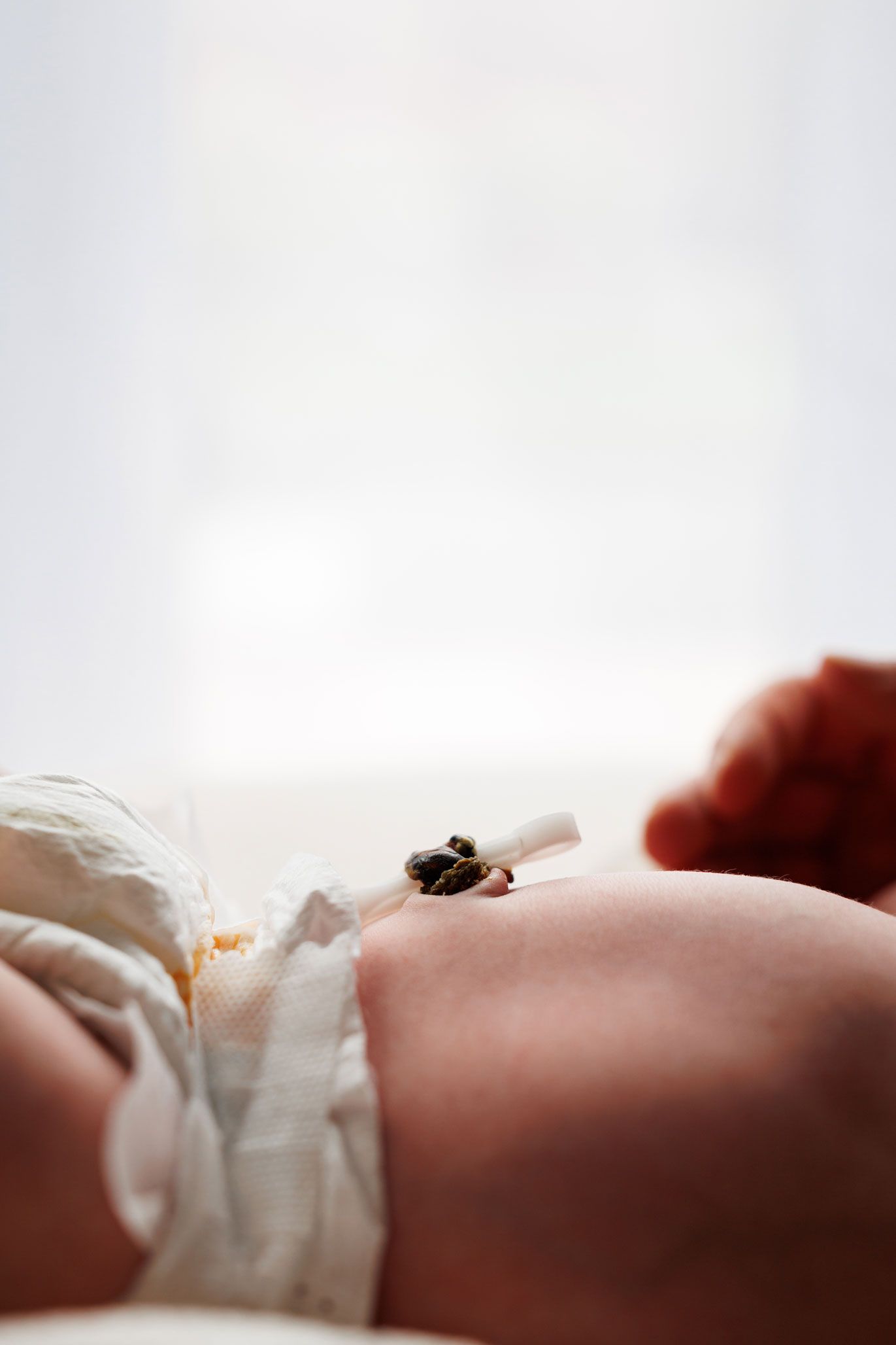 Close-up of a newborn baby's umbilical cord clamp on their belly button, wrapped in a white diaper.