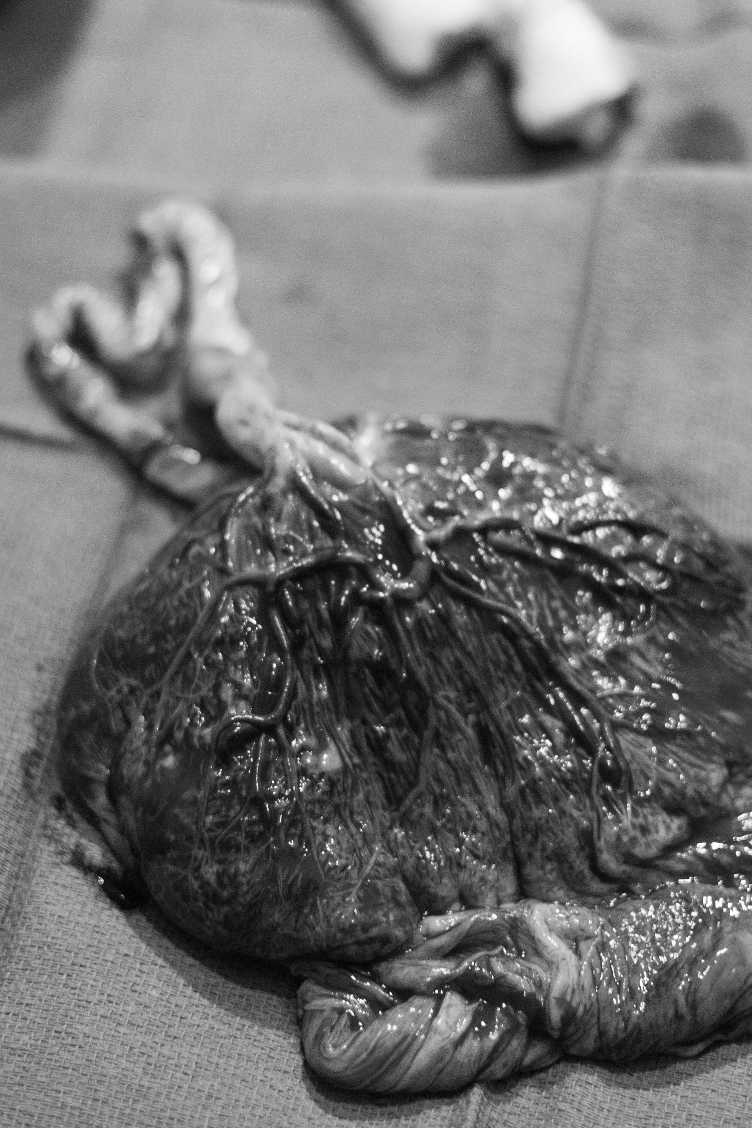 Black and white close-up of a human placenta with umbilical cord after childbirth on a drape.