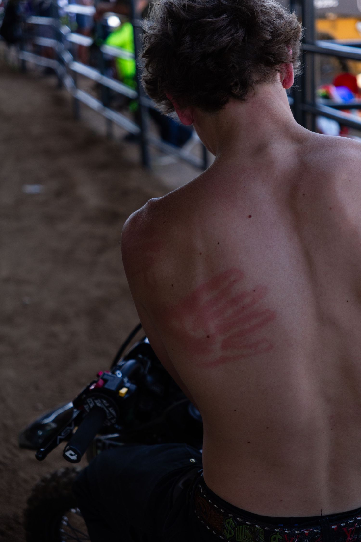Shirtless motocross rider shows red road rash scratches on his back at a dirt bike event.