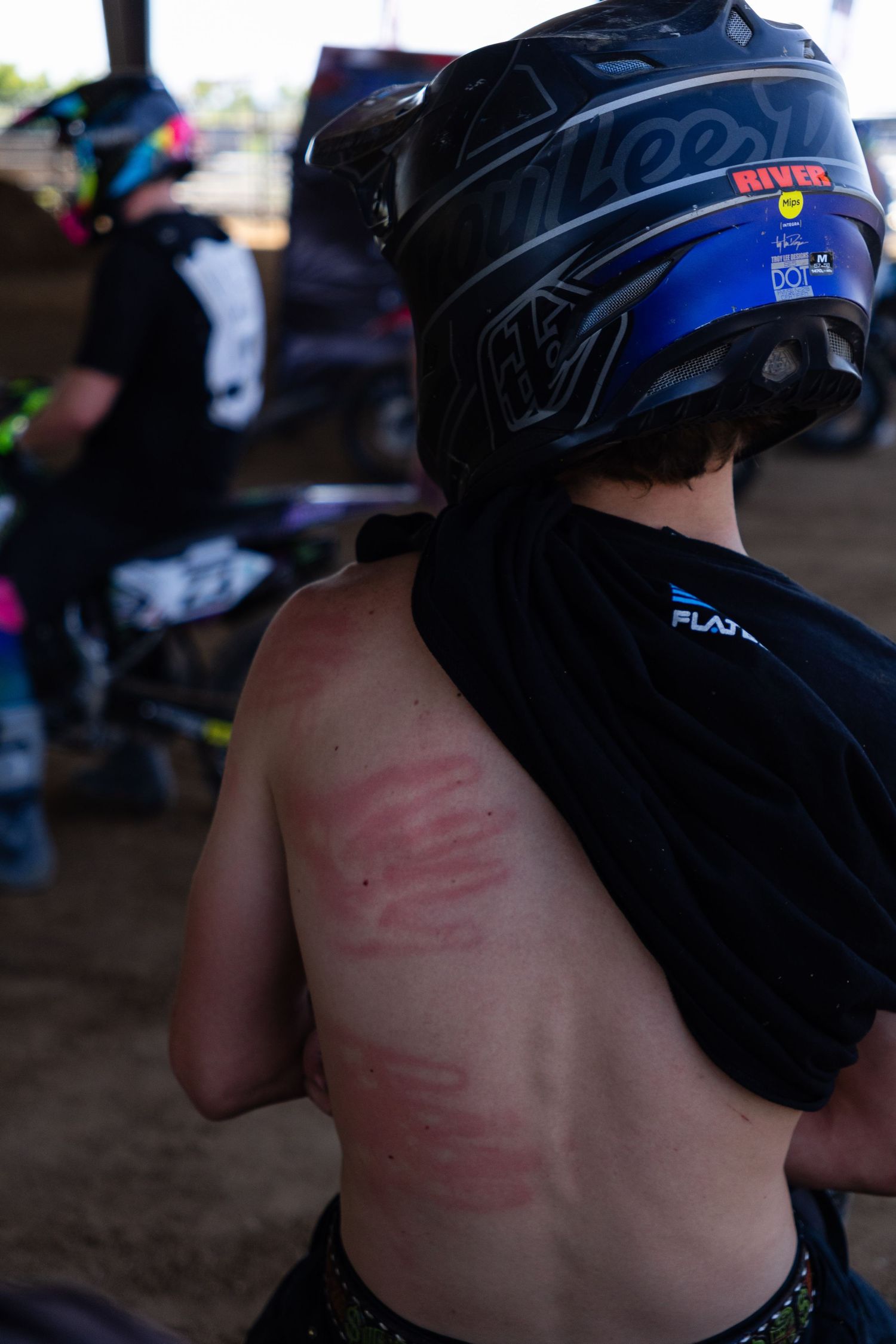 Young motocross rider with helmet shows red road rash marks across his back at a dirt event.