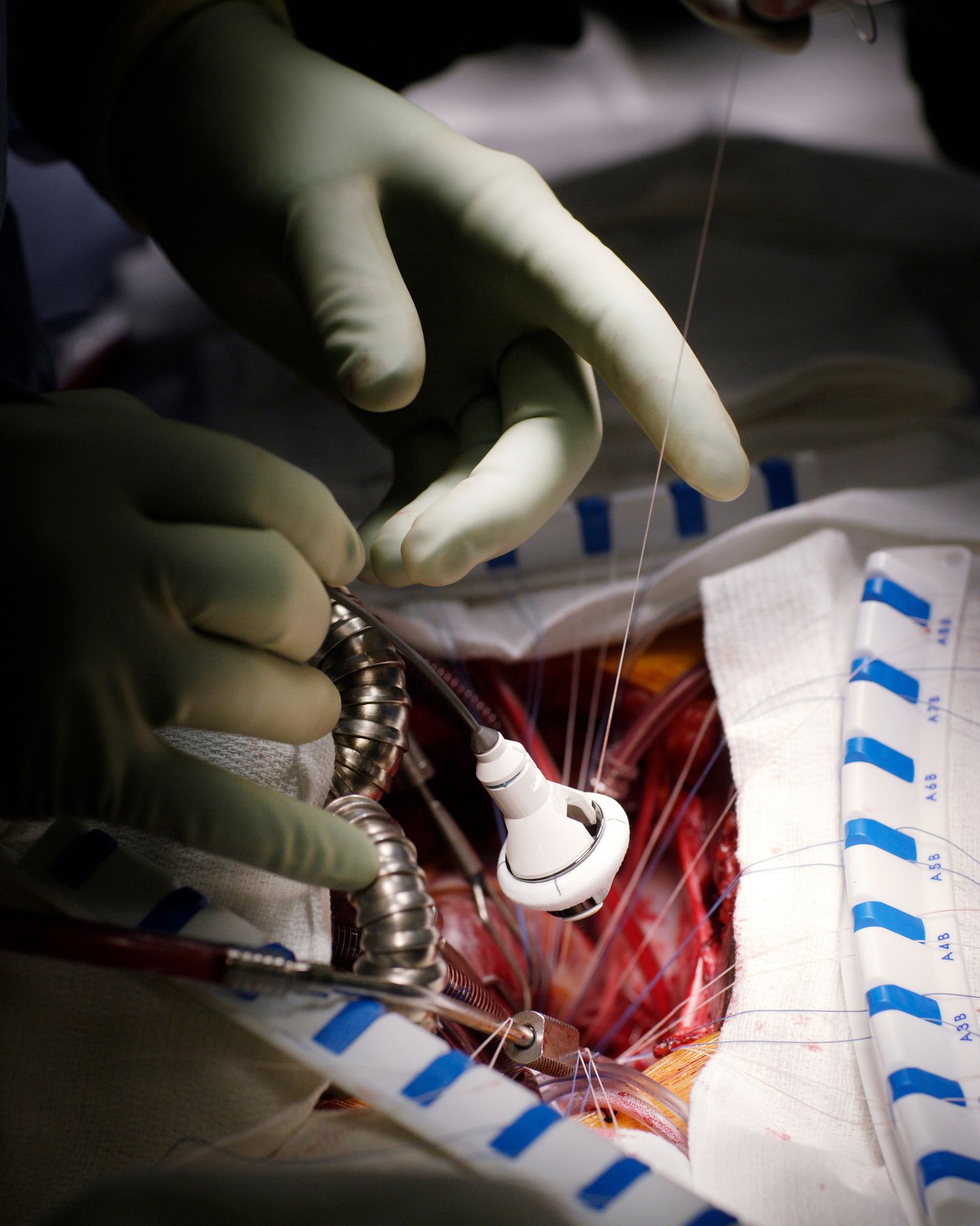 Close-up of surgical procedure showing gloved hands working with medical instruments.