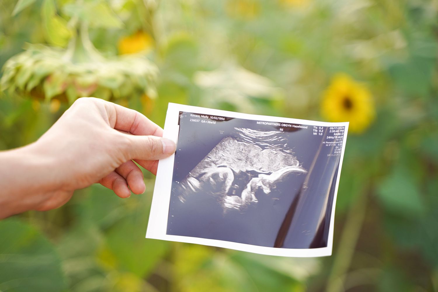 sonogram photo with green sunflower back ground
