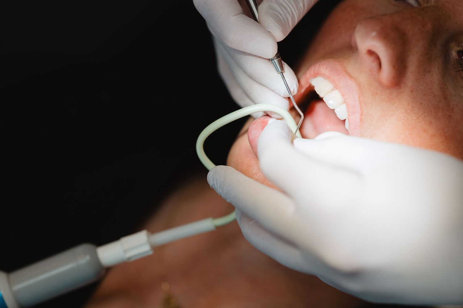 Dentist performing a dental examination on a patient using dental tools and suction device during a checkup.