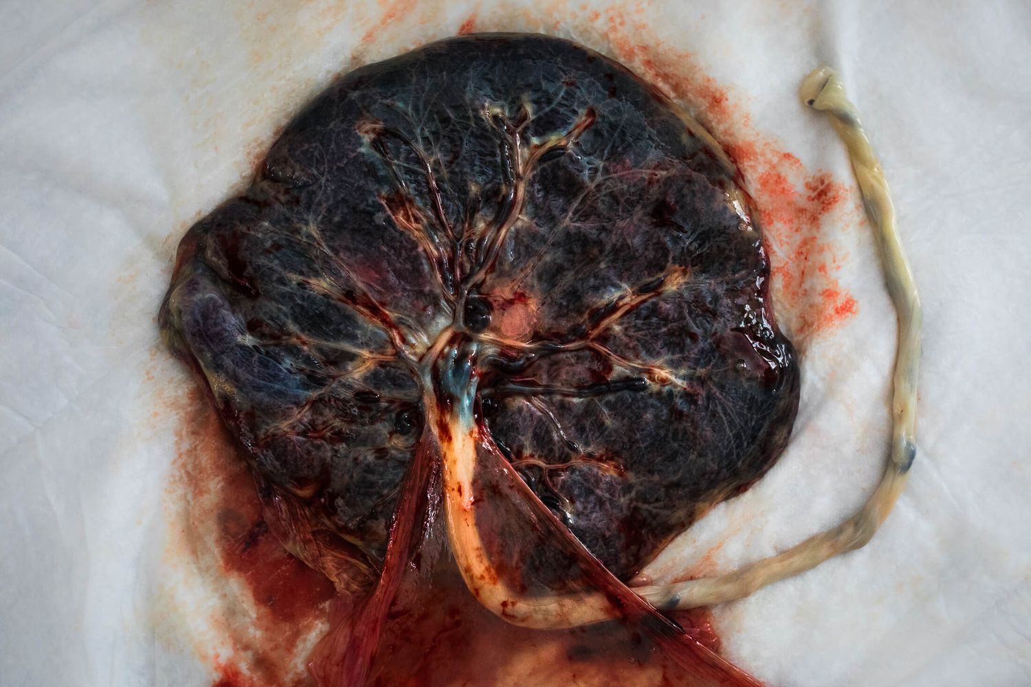Close-up series of a dark circular medical specimen on white background.