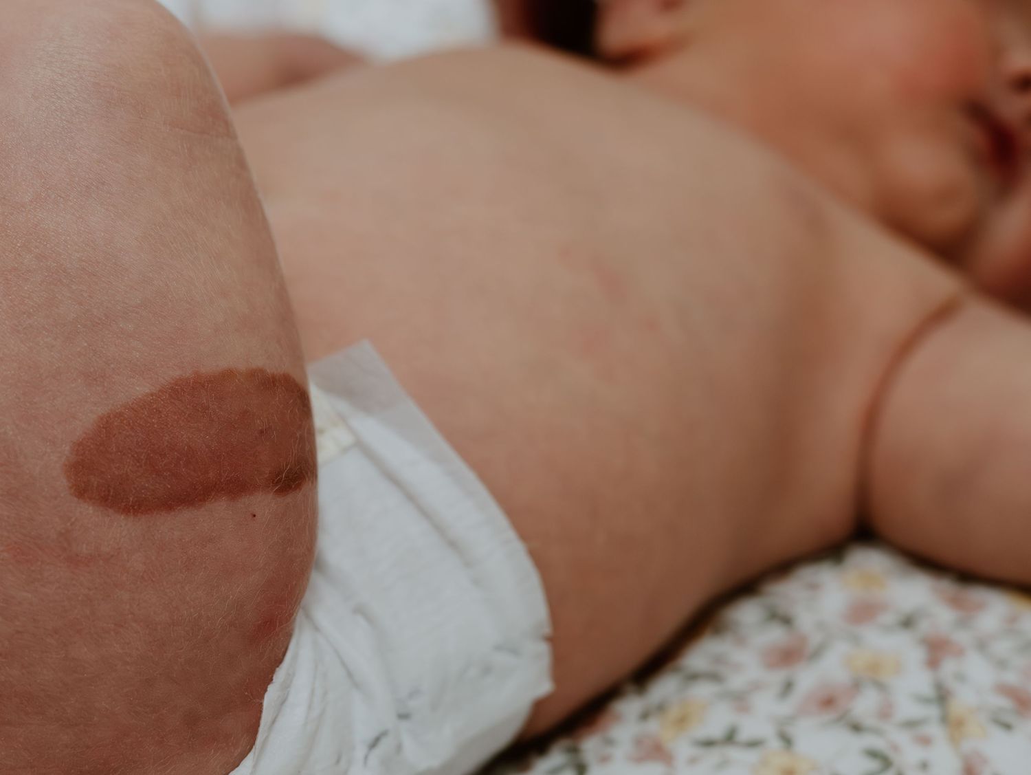 A series of medical bandages applied to a person's skin in a clinical or medical setting.