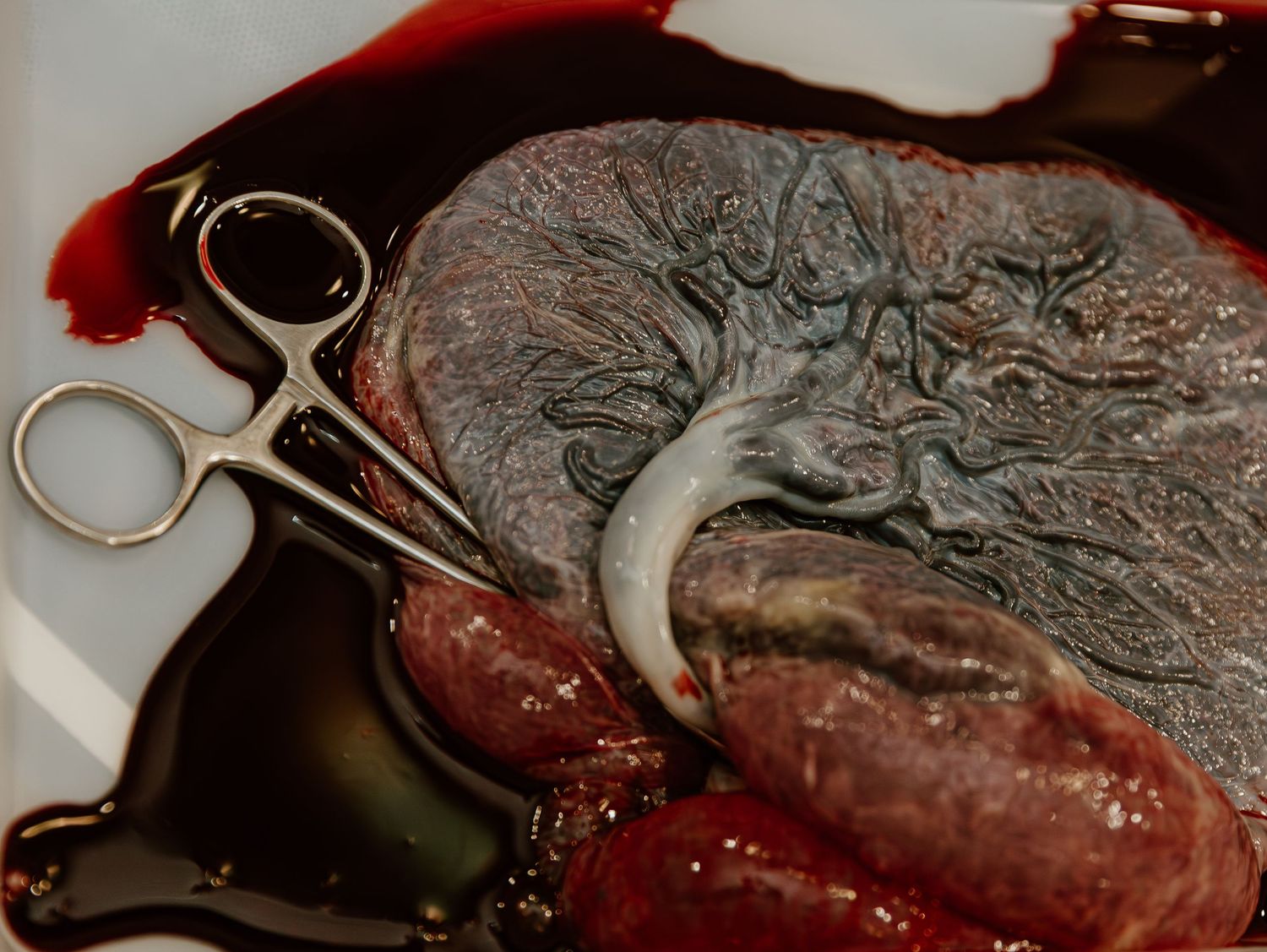 Antique medical instruments with scissors and dried placenta or organ specimens resting on dark surface.