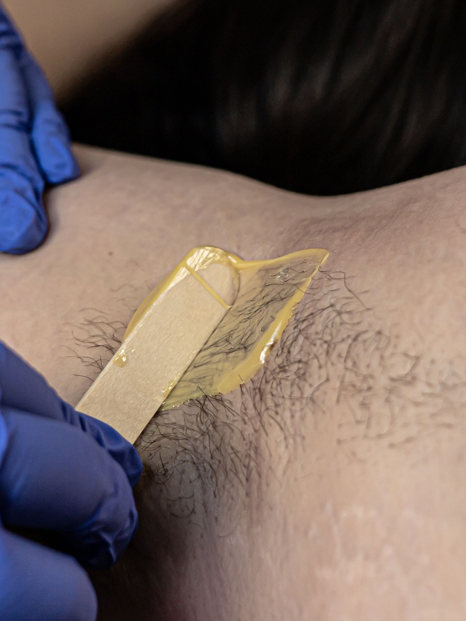 A hand wearing blue medical gloves applies wax strips for hair removal on skin.