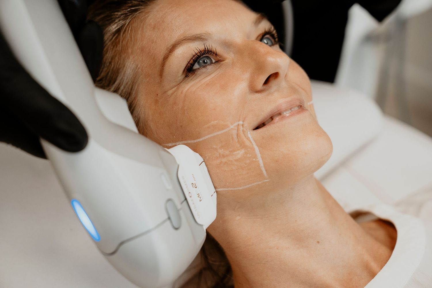 Woman receiving an ultrasound skin tightening facial treatment at a medical spa.