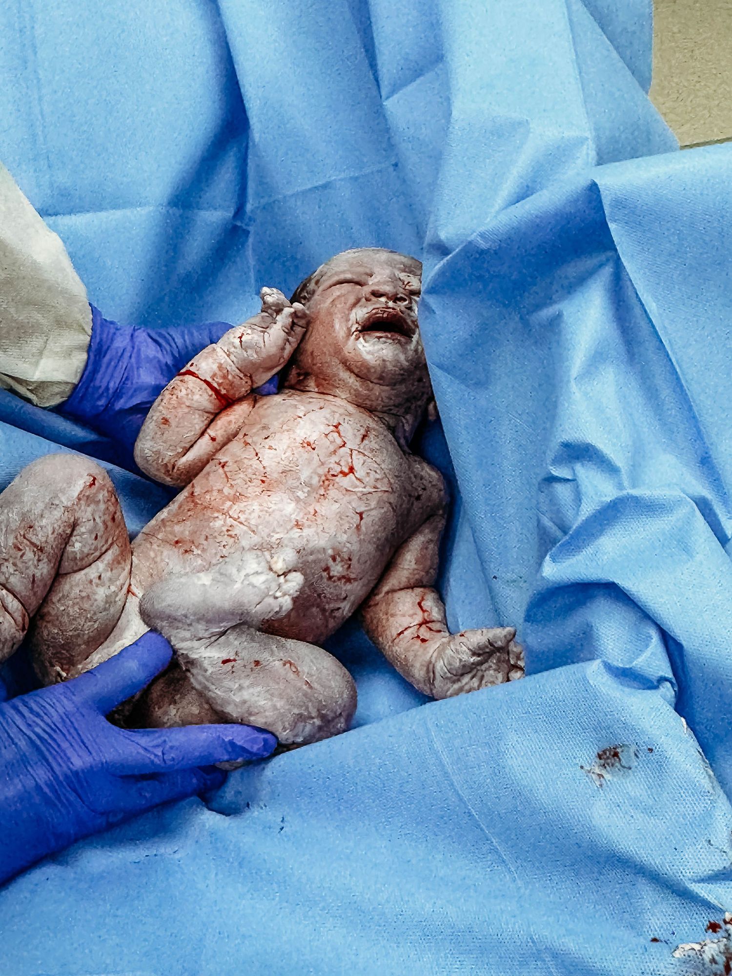 Baby is laid on towel immediately after c-section