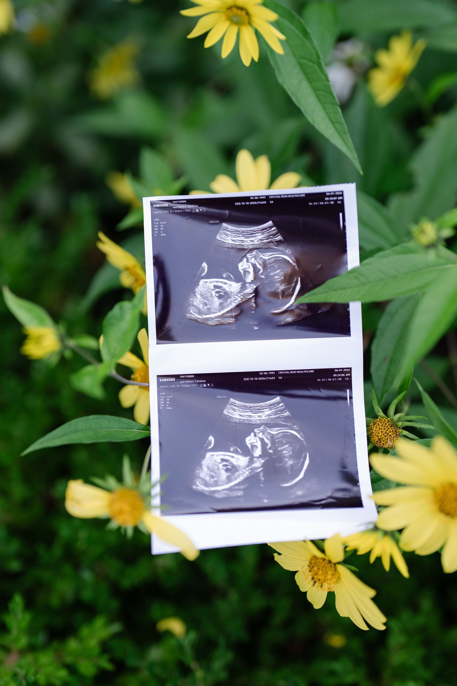 Two ultrasound photos of an unborn baby displayed among yellow wildflowers and green leaves in a garden setting.