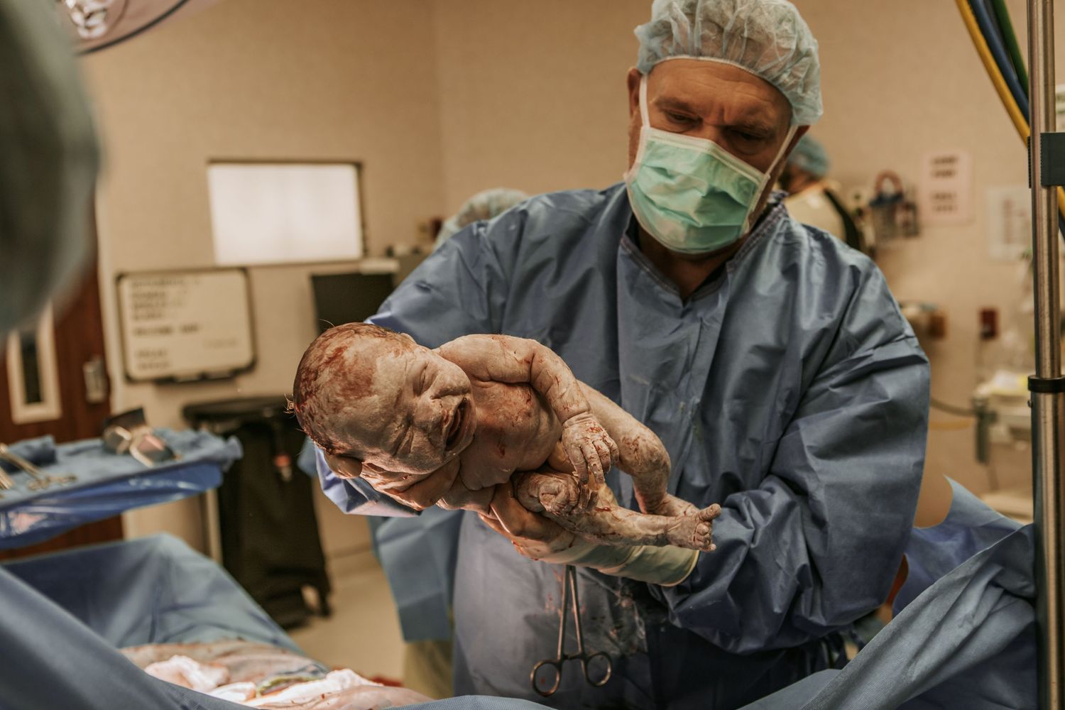 A doctor holds a newborn baby, covered in vernix, up so the mother can see her child for the first time during a C-section.