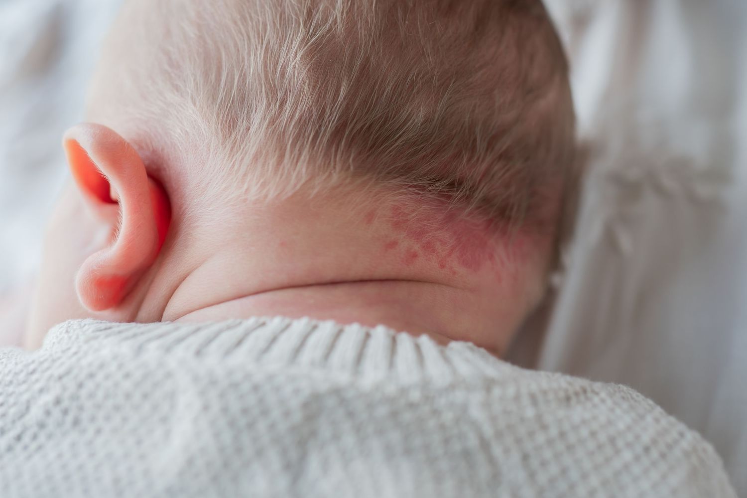 Close-up of a baby's neck showing red eczema rash on skin near the hairline and behind the ear.