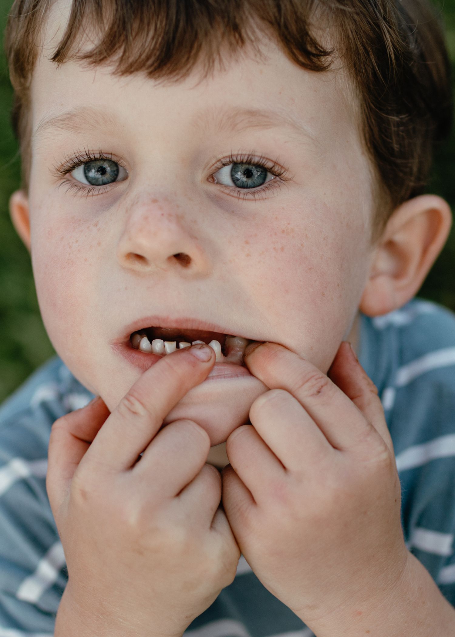 Close-up portrait of a freckled young boy with blue eyes and brown hair showing his wobbly loose tooth while wearing a striped shirt.