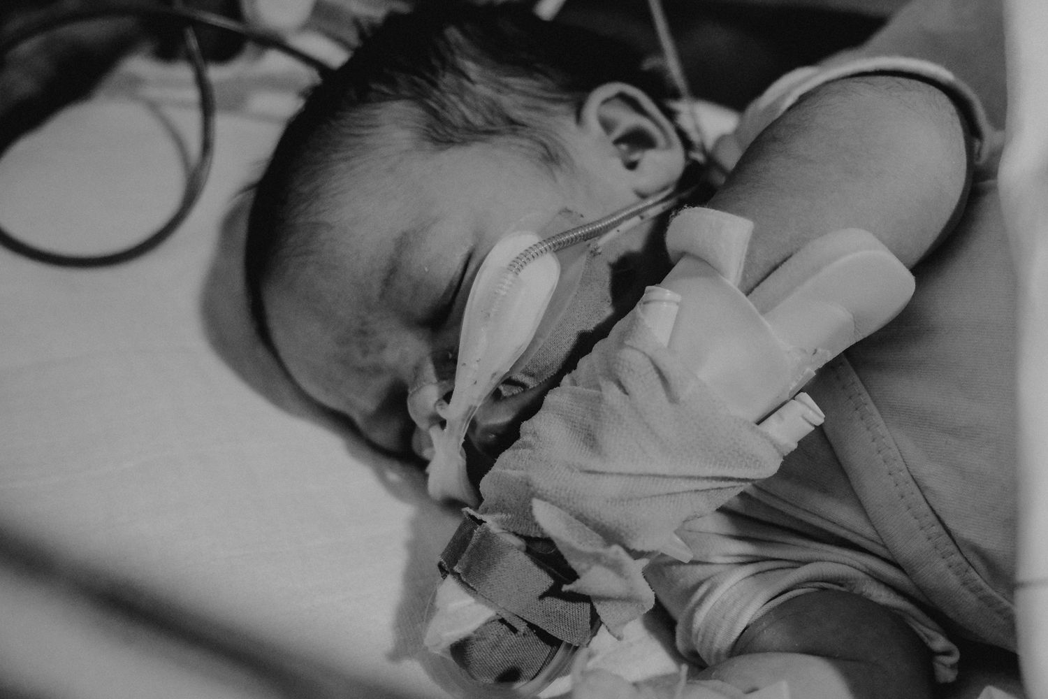 Black and white photo of a premature newborn baby in the NICU with oxygen mask and medical equipment.