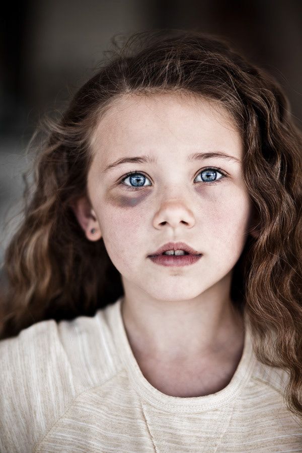 Portrait of a young girl with blue eyes, freckles, and a bruise under her eye.