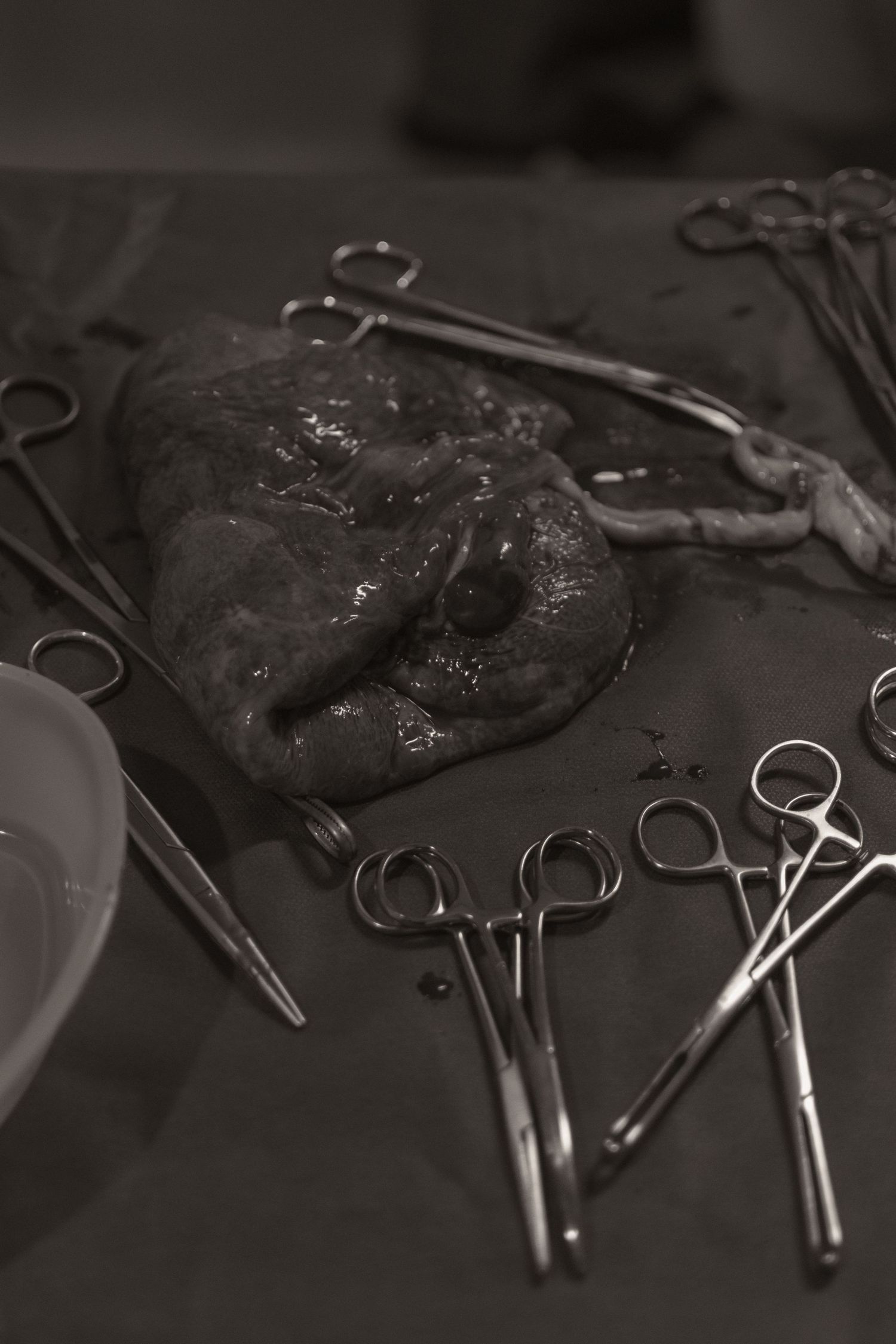 Surgical instruments and hemostatic clamps arranged around an organ specimen on a dark surgical drape.