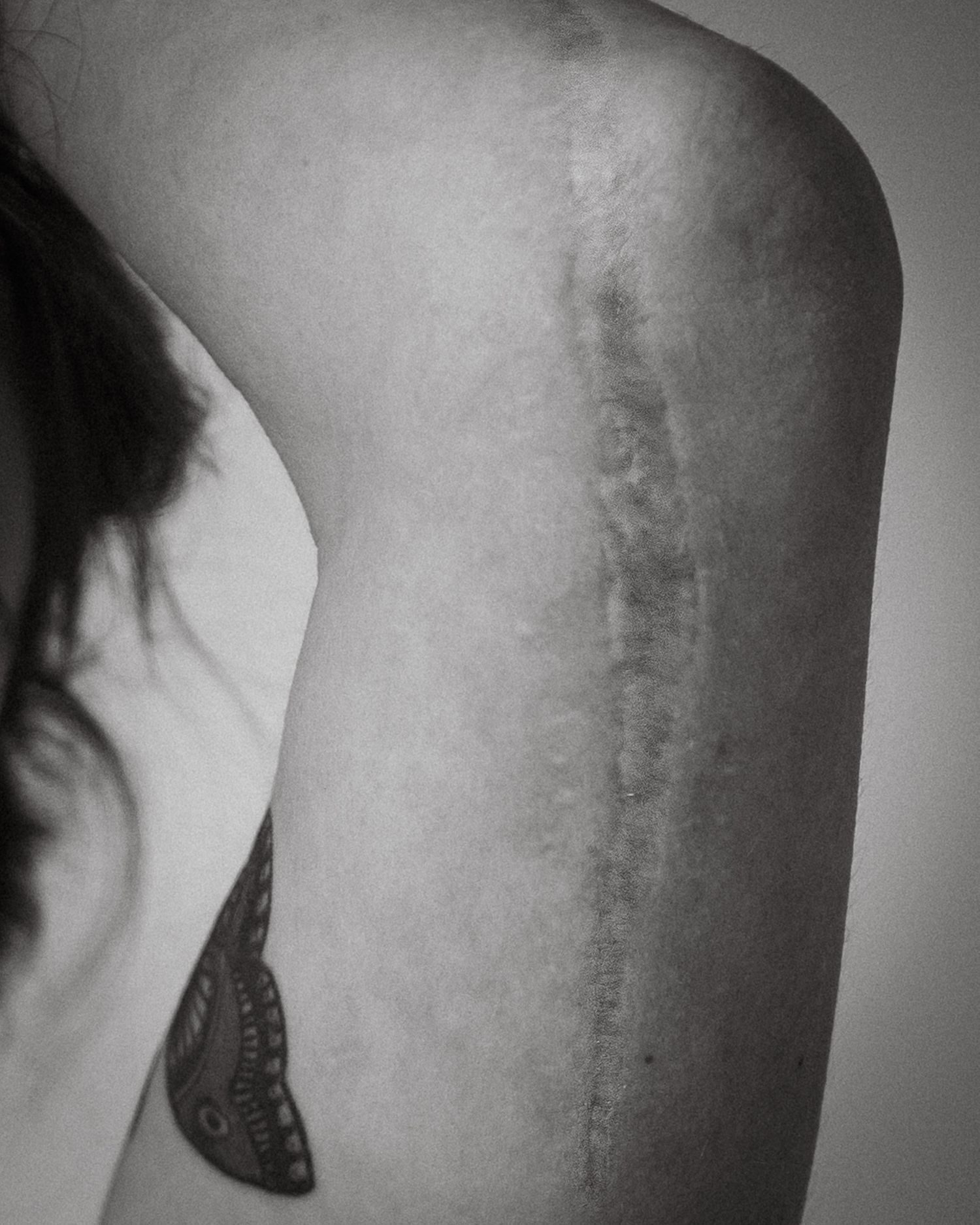 A black and white photograph of a long scar down an arm.