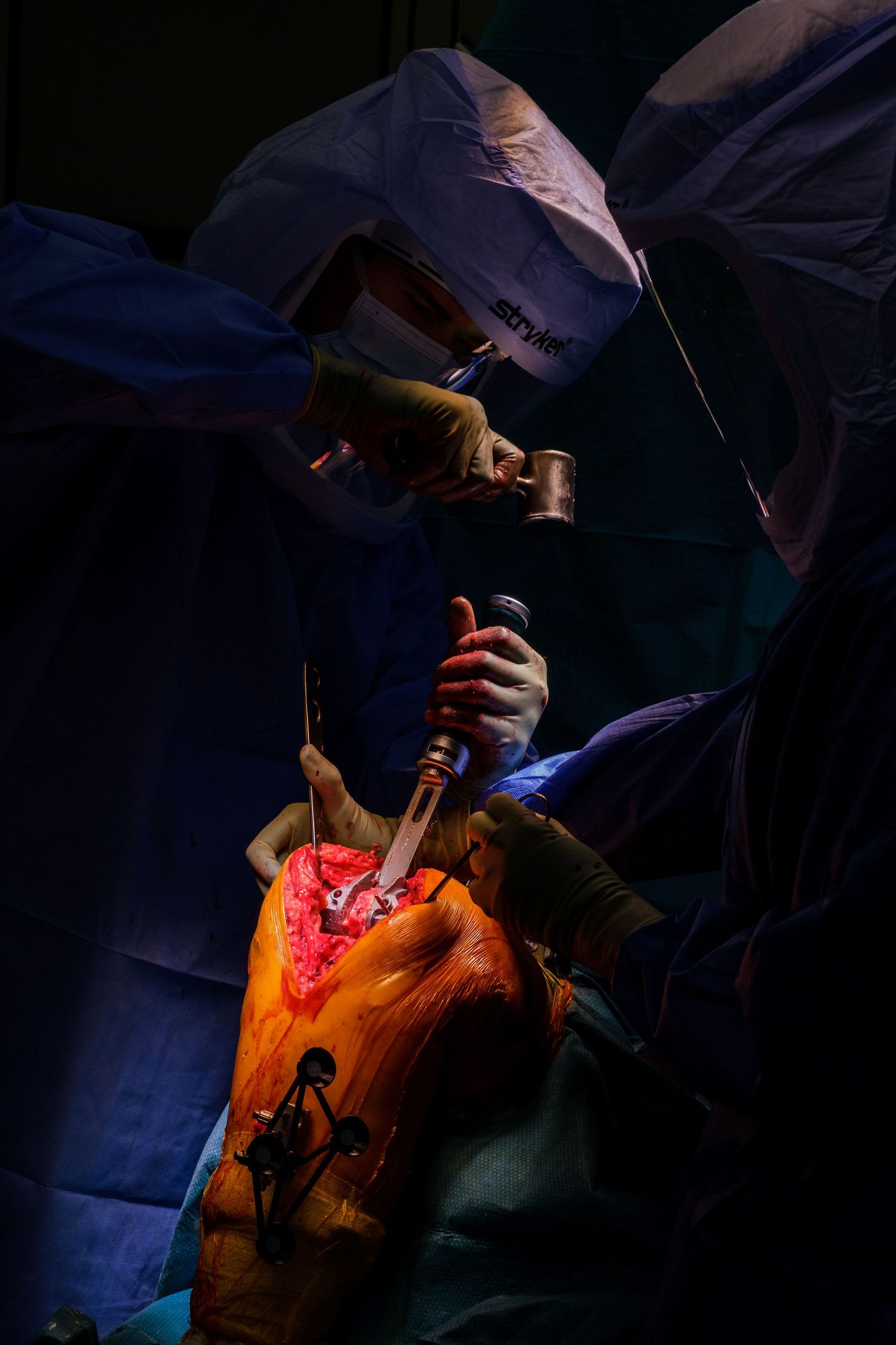 Dramatic surgical procedure illuminated in dark blue and orange lighting.