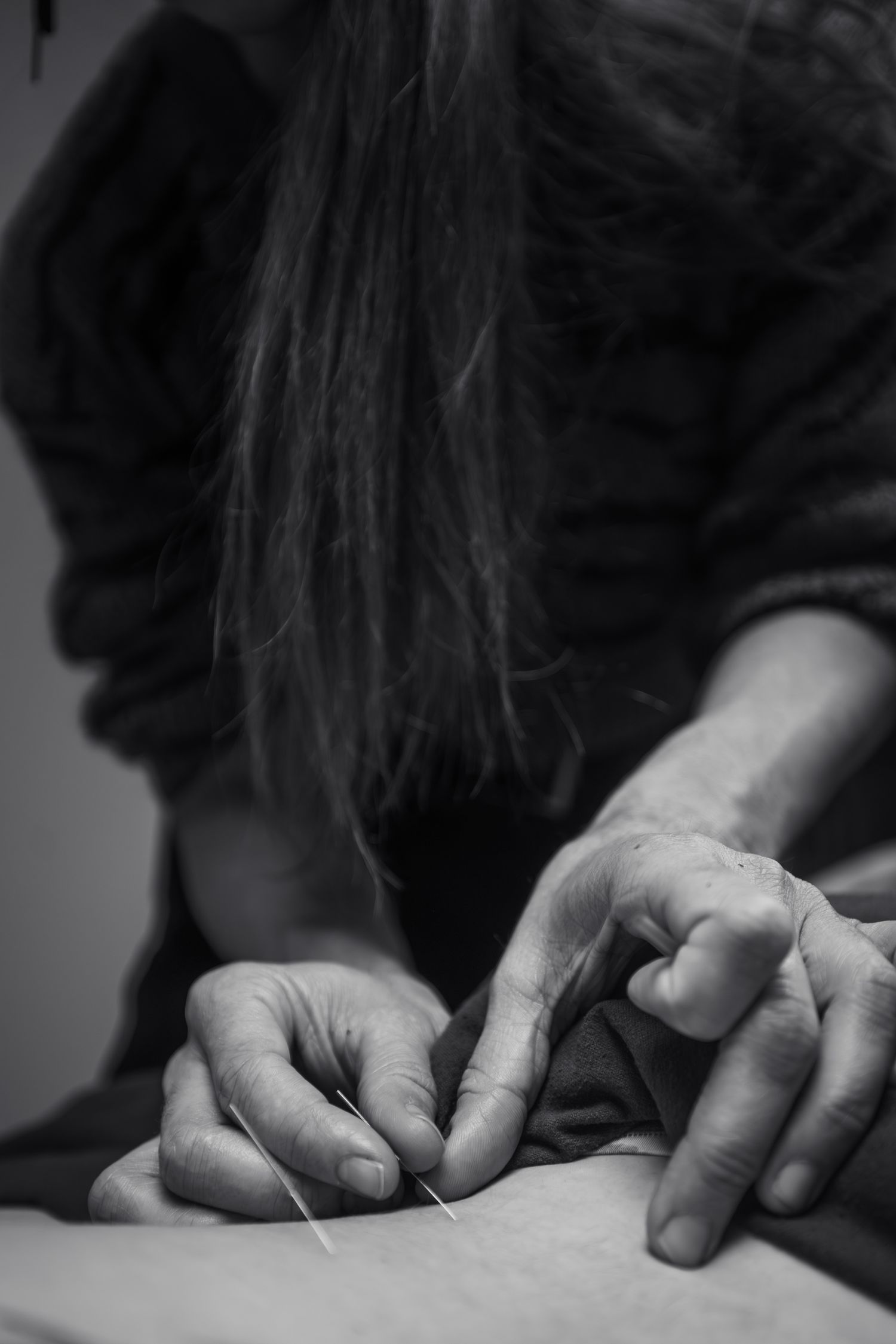 Black and white photo of acupuncturist inserting thin acupuncture needles into a patient's skin during a treatment session.