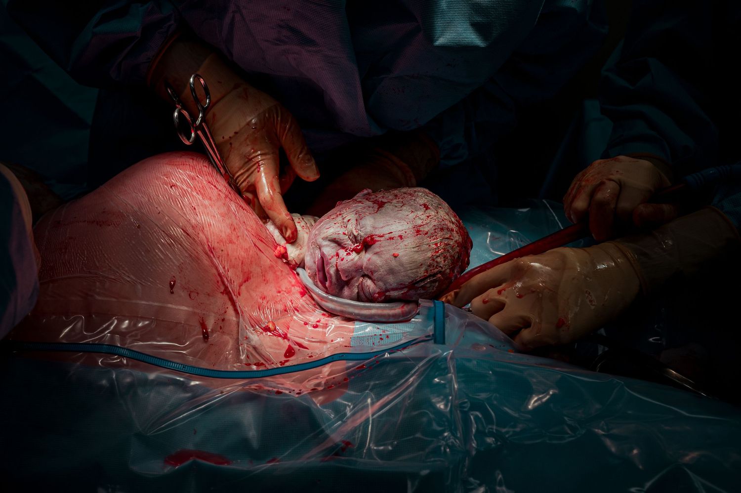 Close-up of surgical procedure being performed under dramatic red lighting.